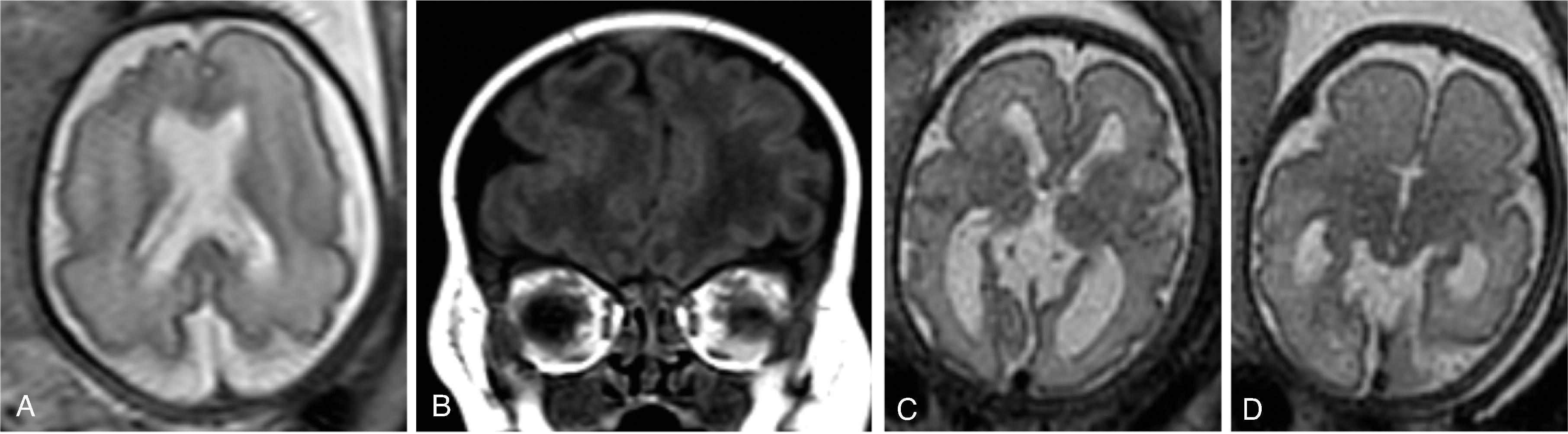 Fig. 2.41, Polymicrogyria .