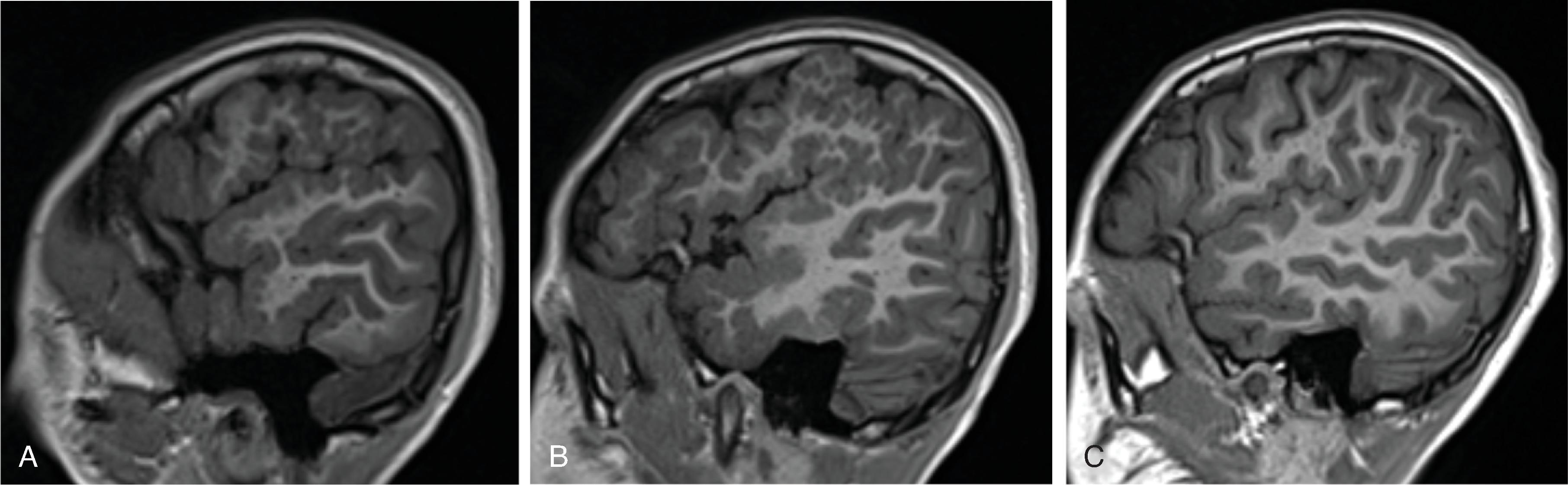 Fig. 2.42, Polymicrogyria .