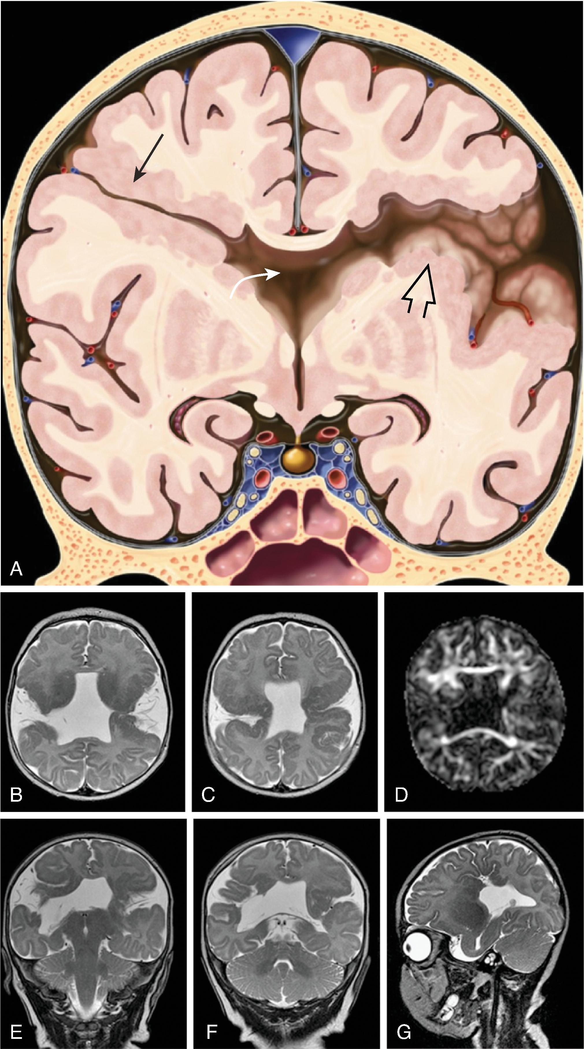 Fig. 2.43, Schizencephaly .