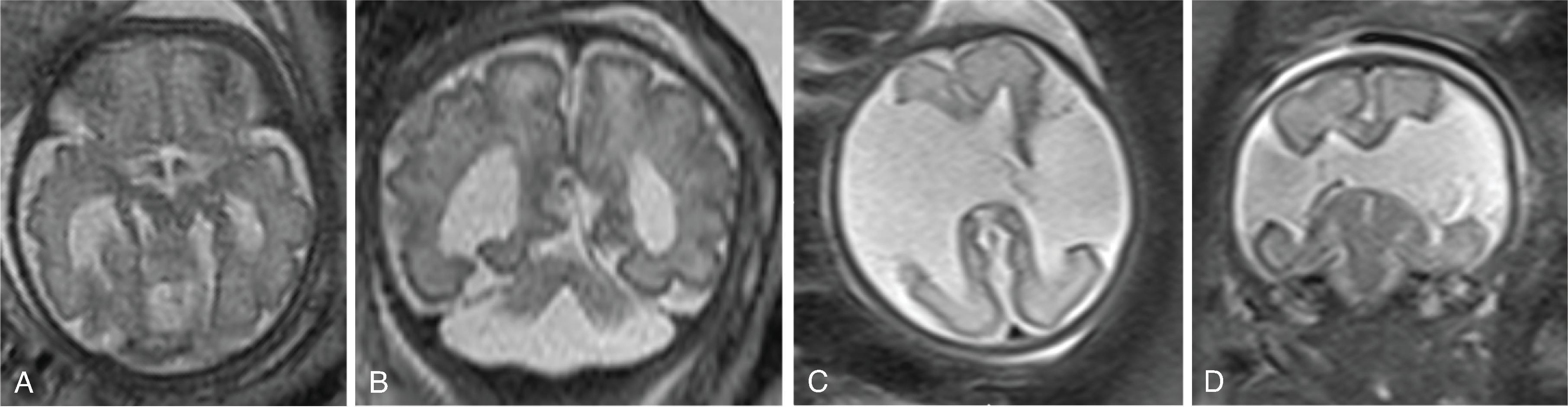 Fig. 2.44, Schizencephaly .