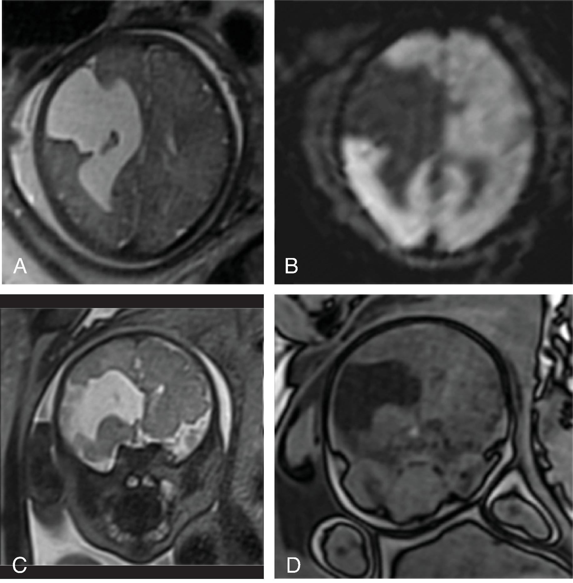 Fig. 2.45, Porencephalic Cyst .