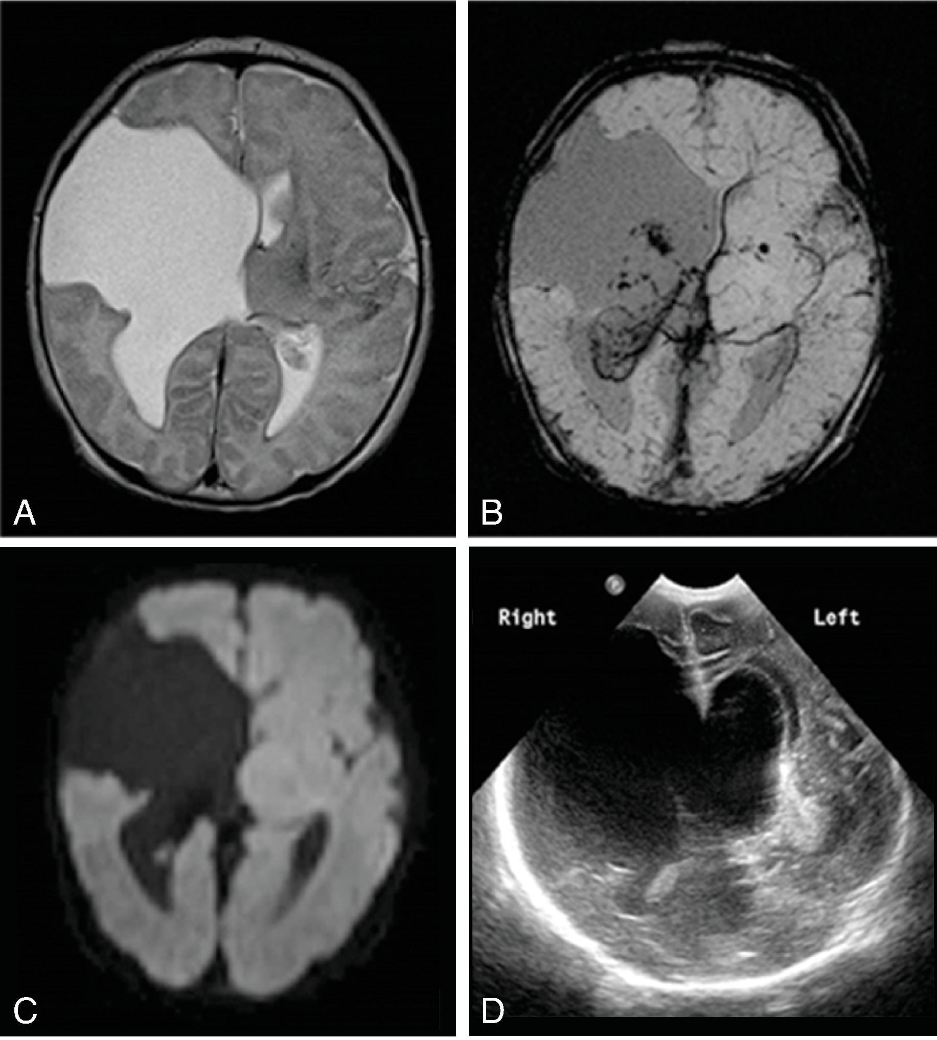 Fig. 2.46, Porencephalic Cyst .