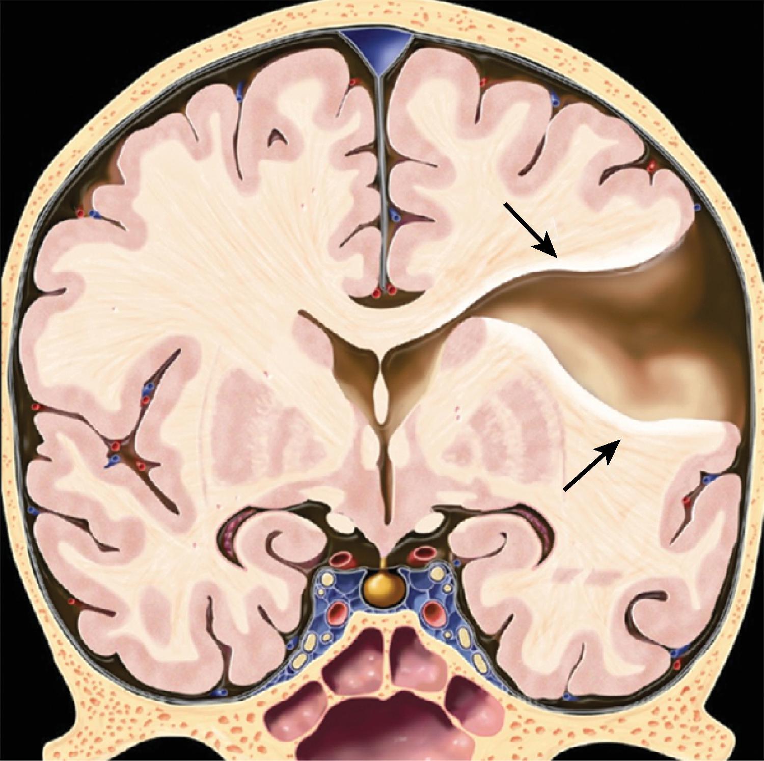 Fig. 2.48, Porencephalic Cyst .