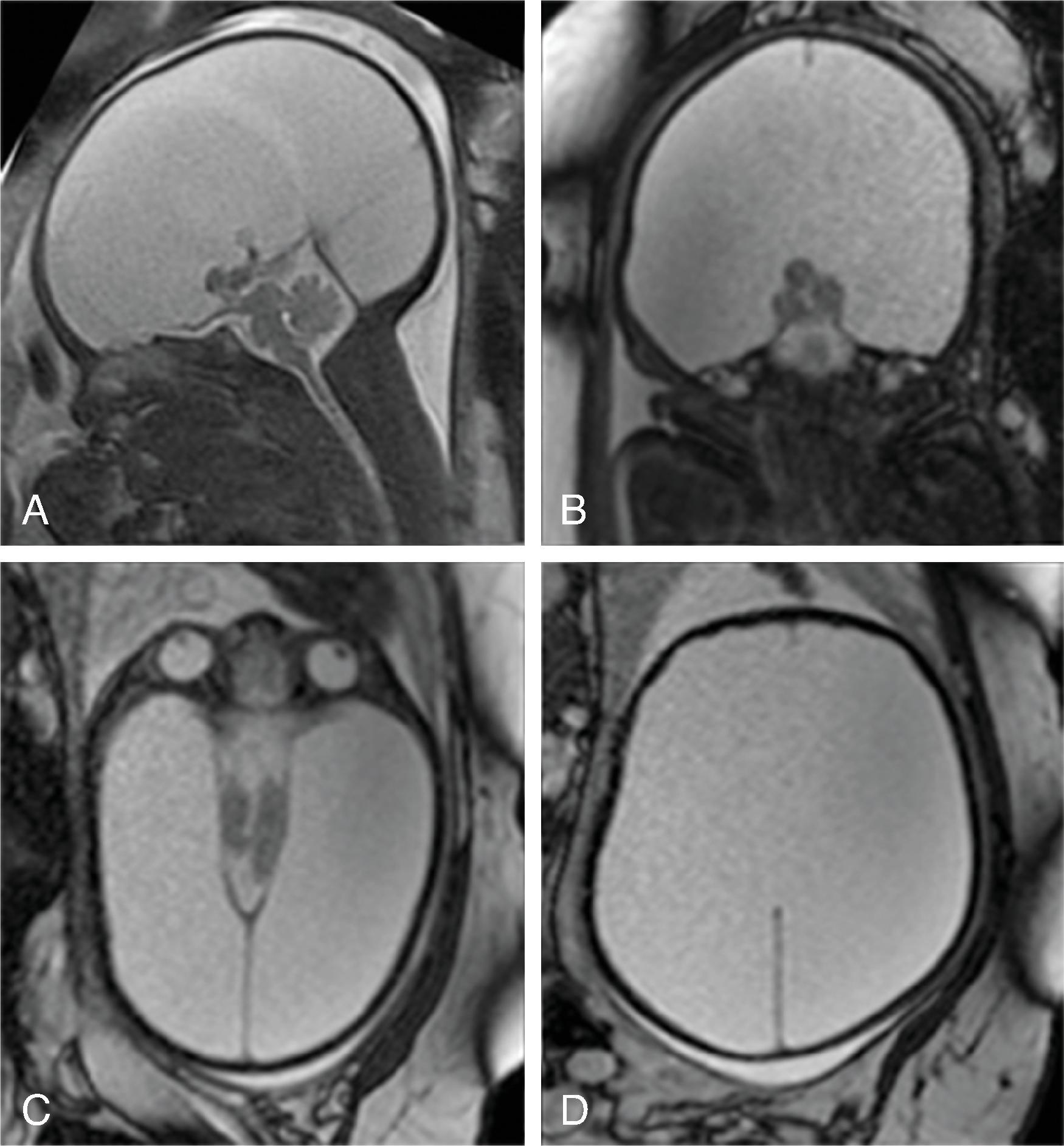 Fig. 2.49, Hydranencephaly .