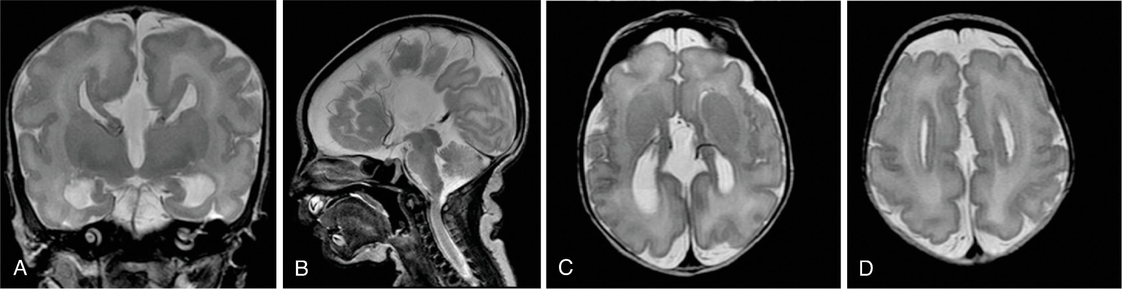 Fig. 2.4, Agenesis of the Corpus Callosum .