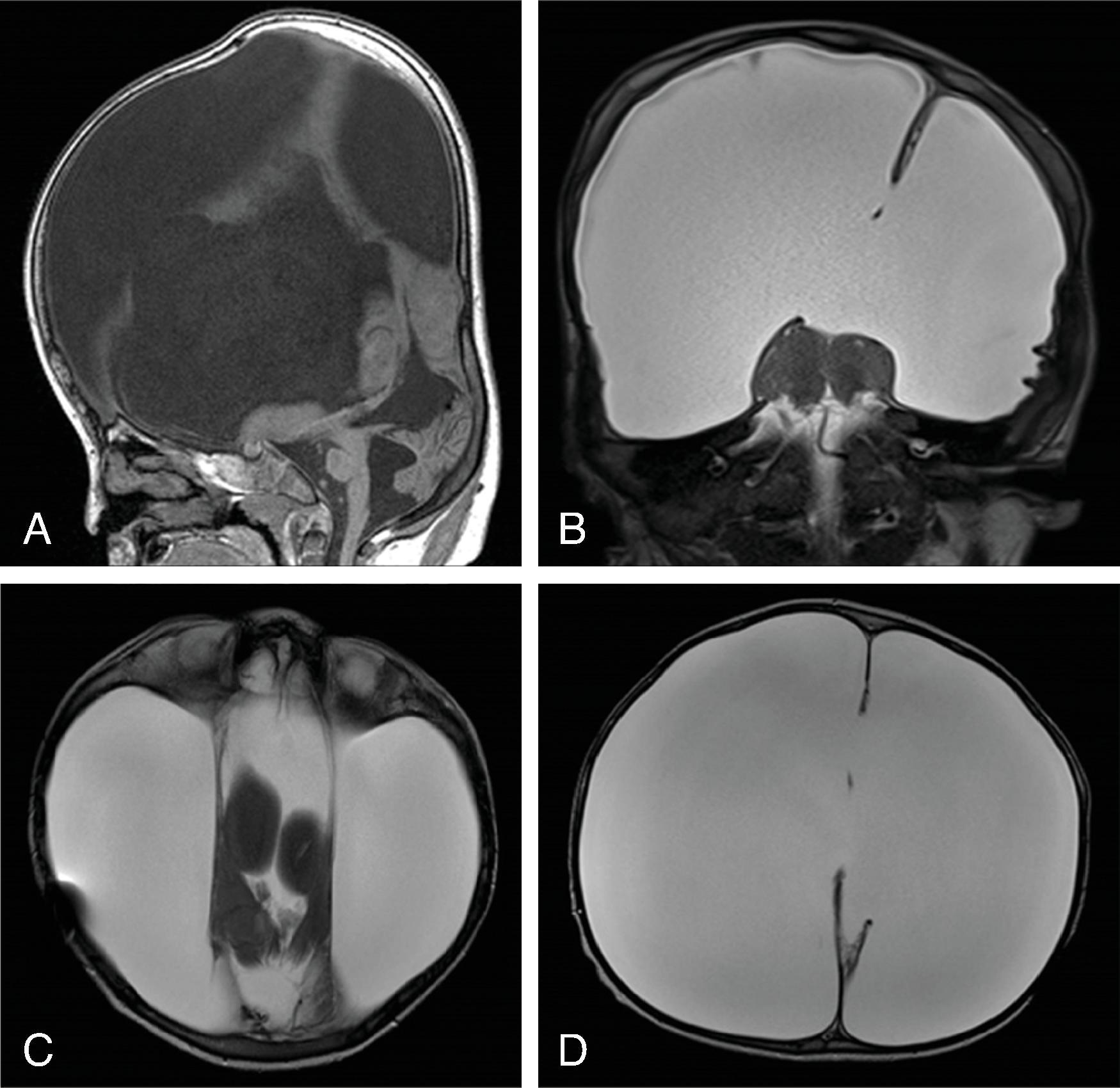 Fig. 2.50, Hydranencephaly .