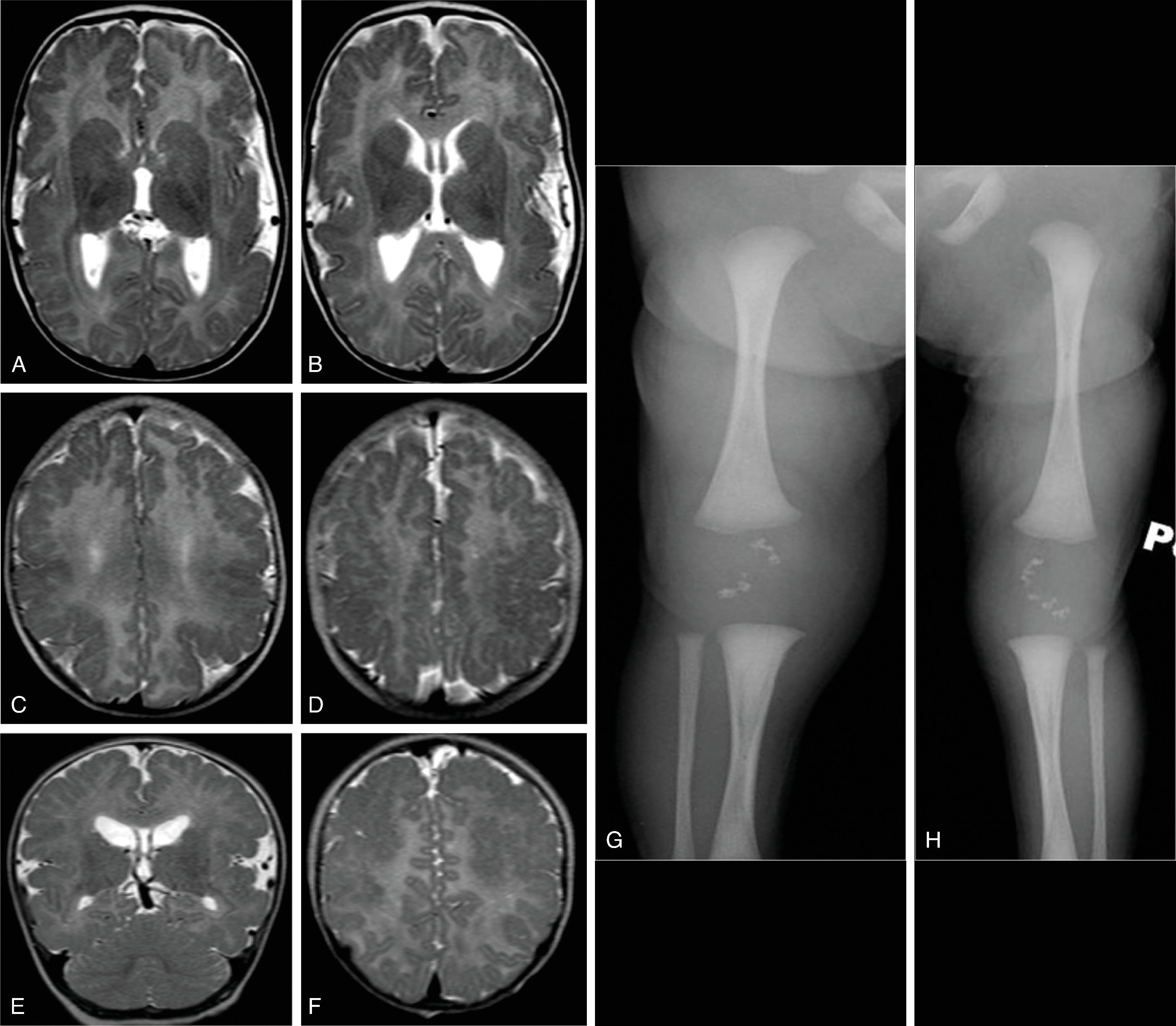 Fig. 2.51, Zellweger Syndrome .