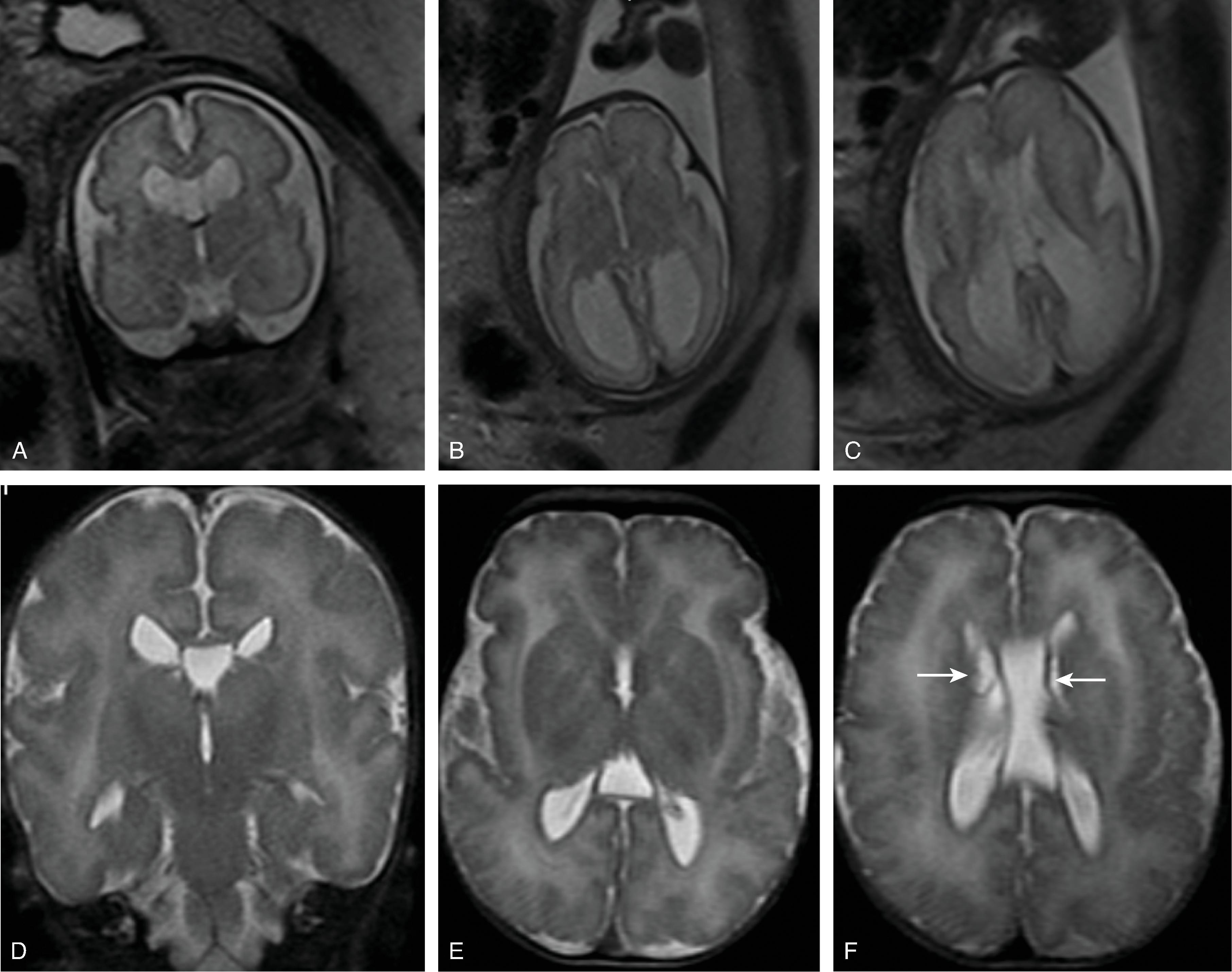 Fig. 2.52, Zellweger Syndrome .