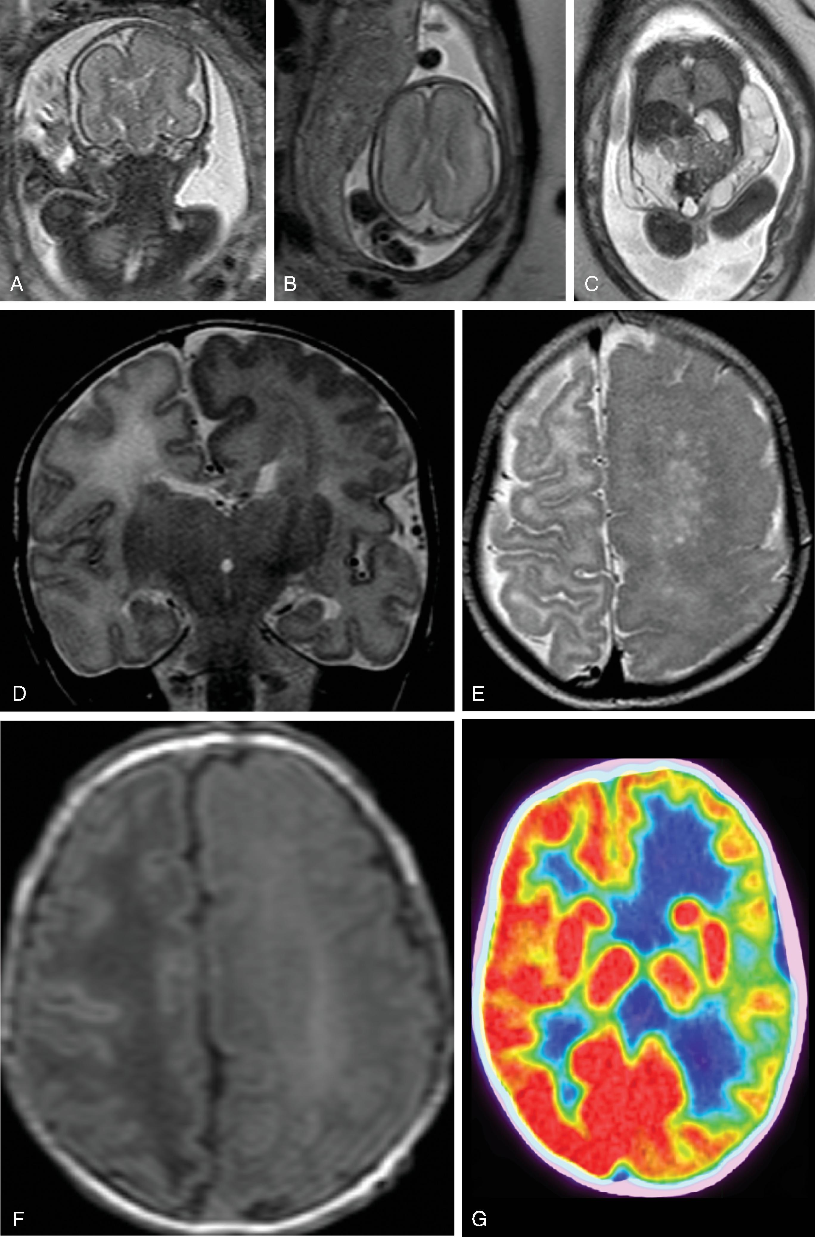 Fig. 2.53, PIK3CA-Overgrowth Syndrome .