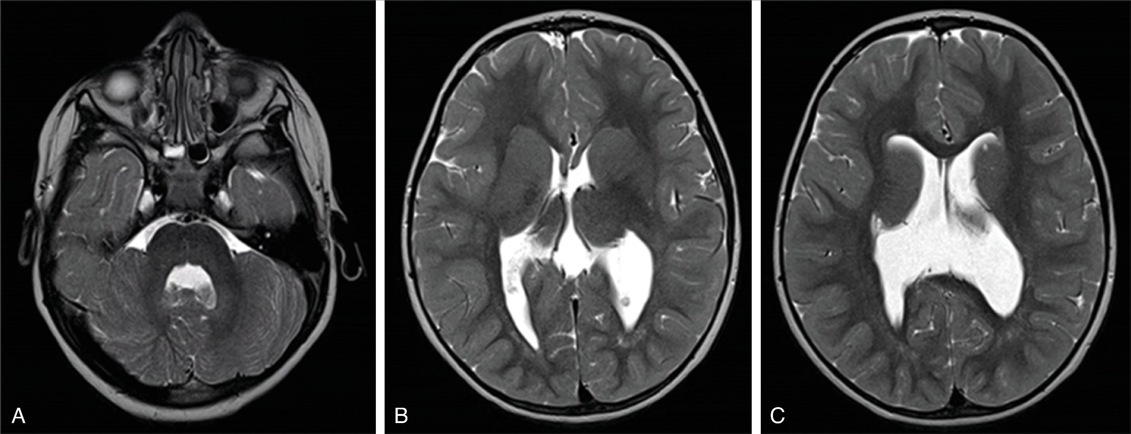 Fig. 2.55, Tubulinopathy .