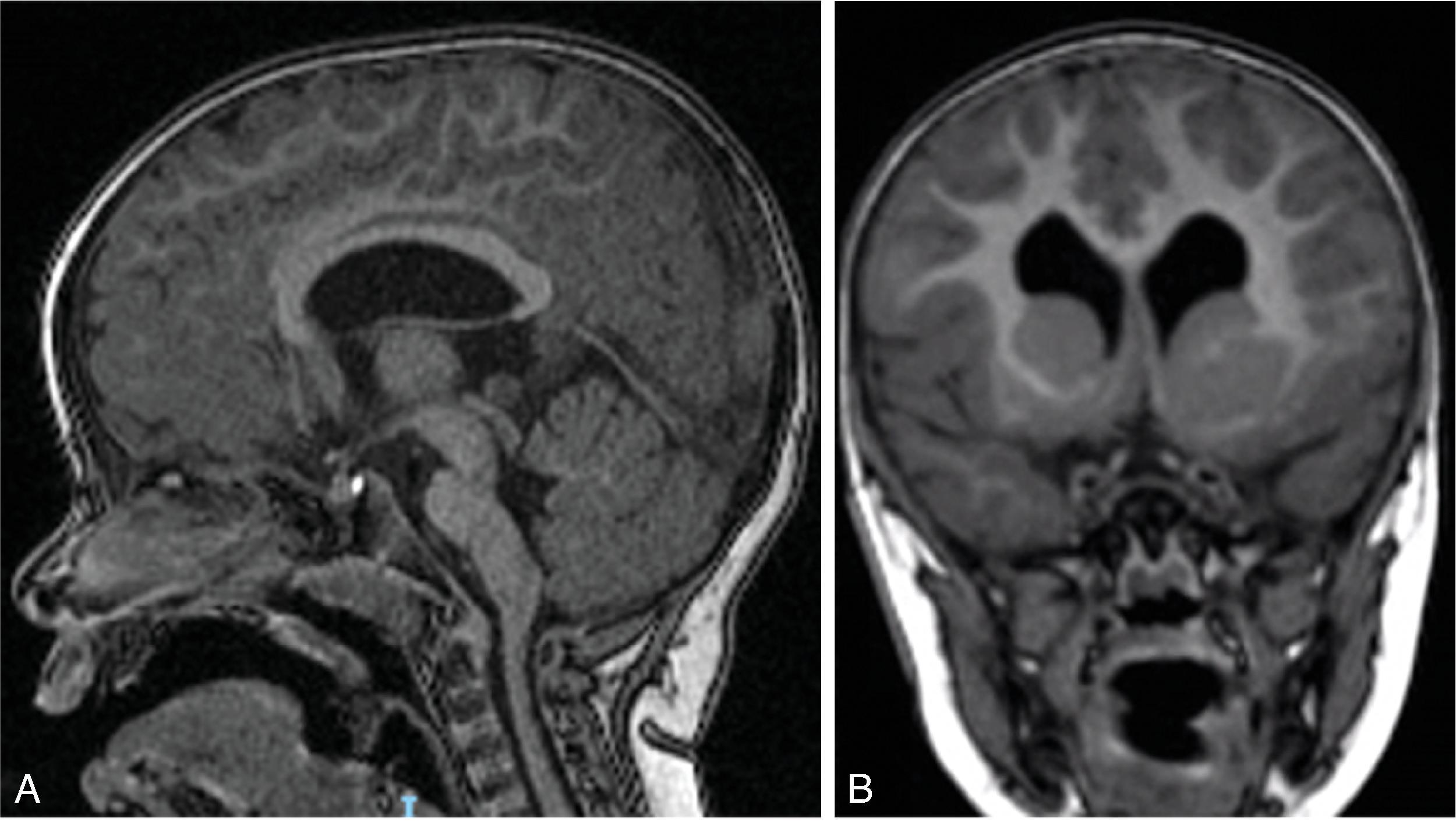 Fig. 2.56, Tubulinopathy .