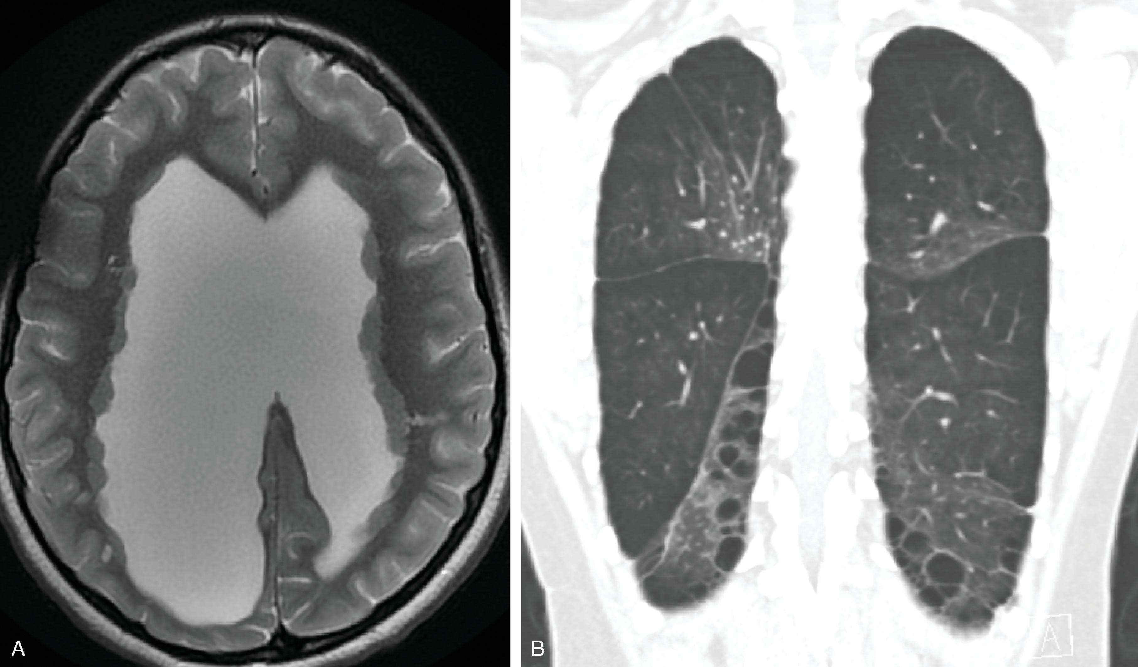 Fig. 2.58, Filamin A Deficiency .