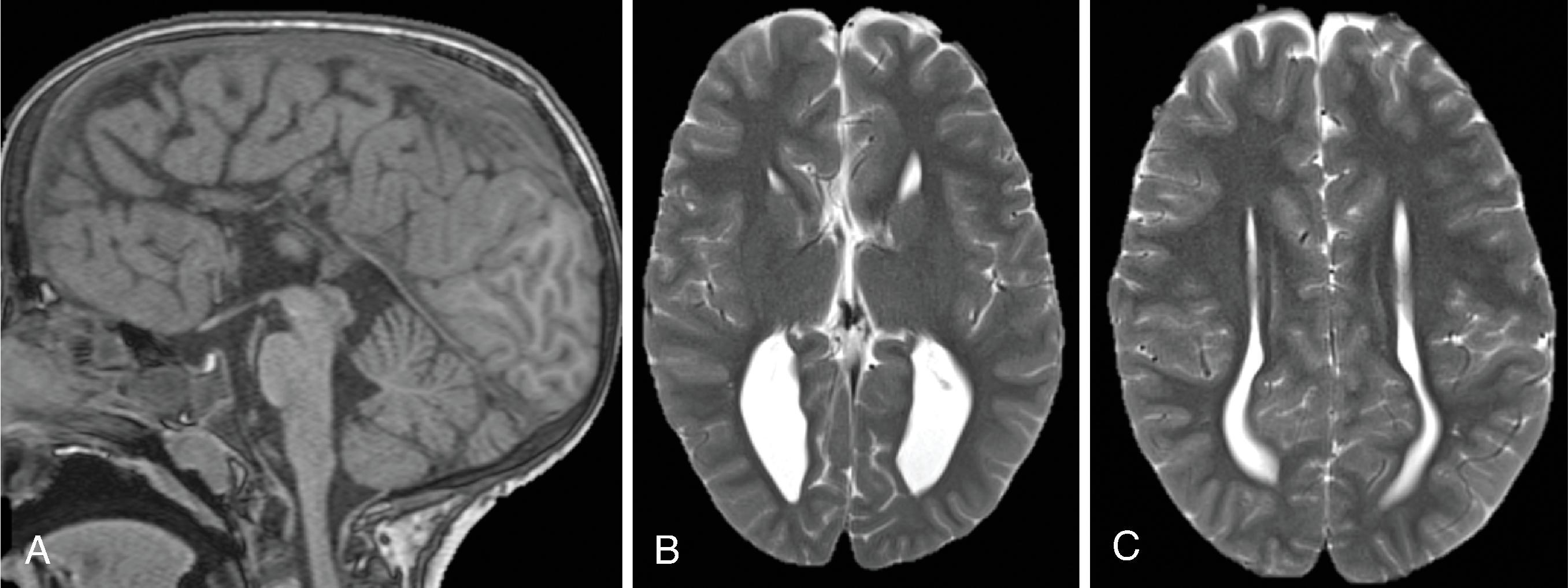 Fig. 2.5, Agenesis of the Corpus Callosum .