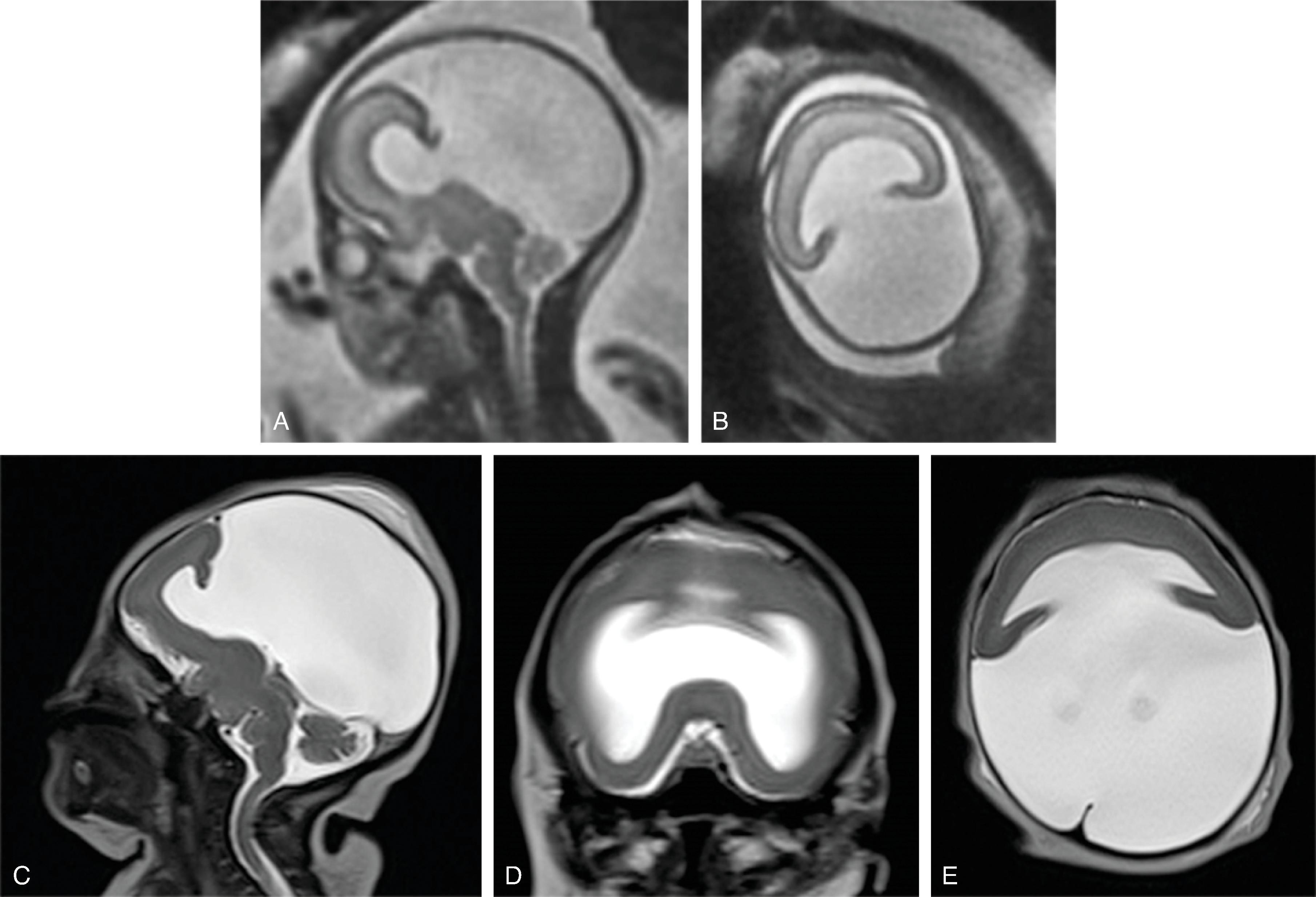 Fig. 2.60, Alobar Holoprosencephaly .