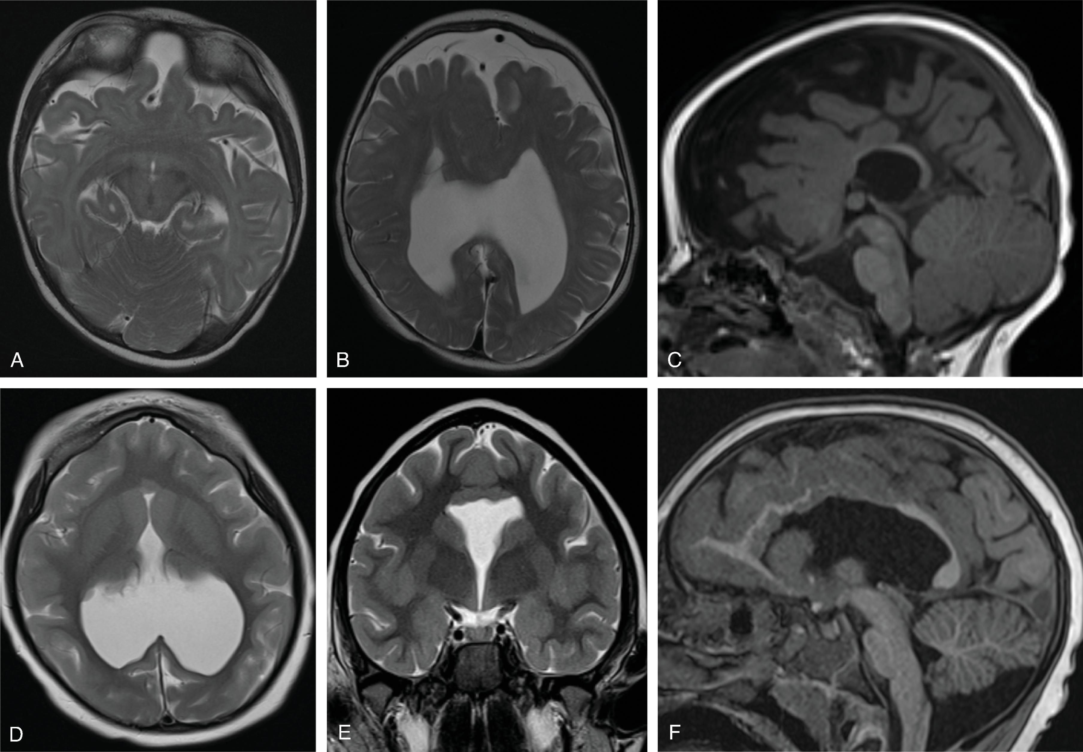 Fig. 2.61, Semilobar Holoprosencephaly .