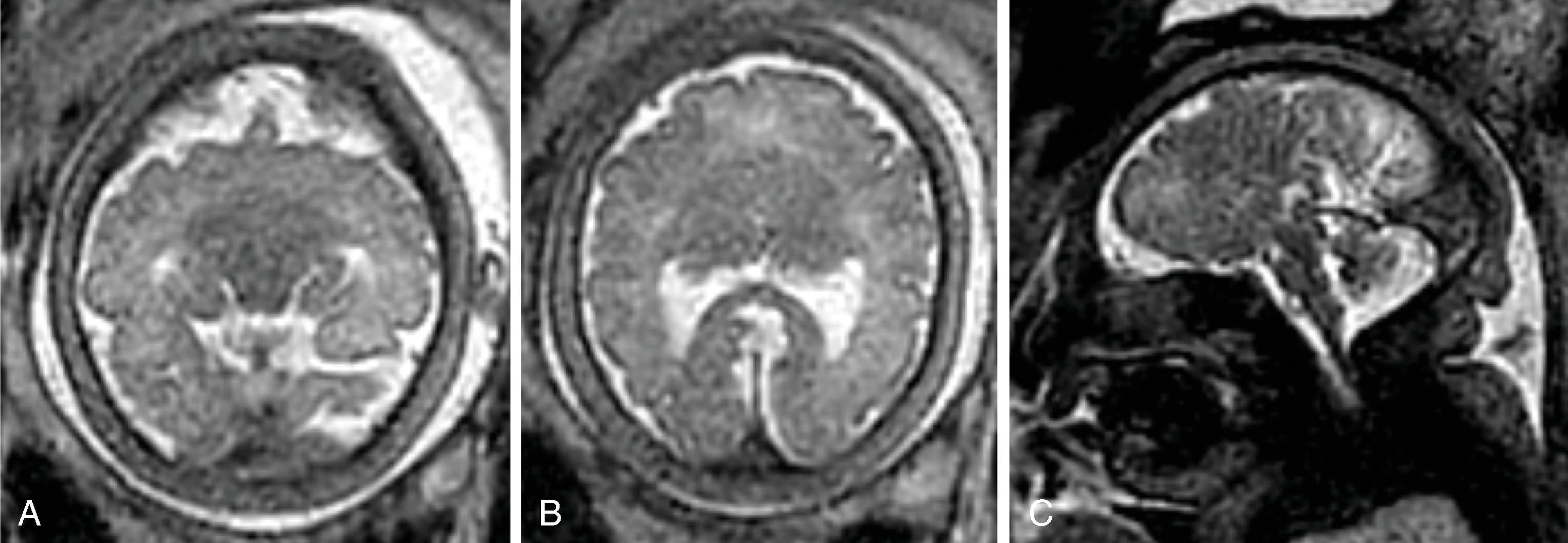 Fig. 2.62, Semilobar Holoprosencephaly .