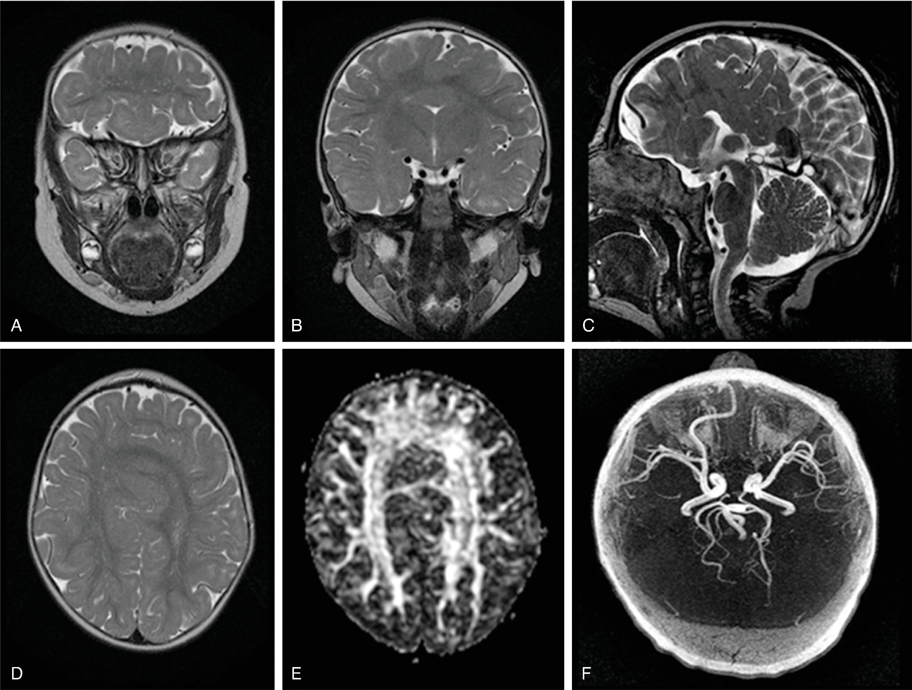 Fig. 2.63, Semilobar Holoprosencephaly .