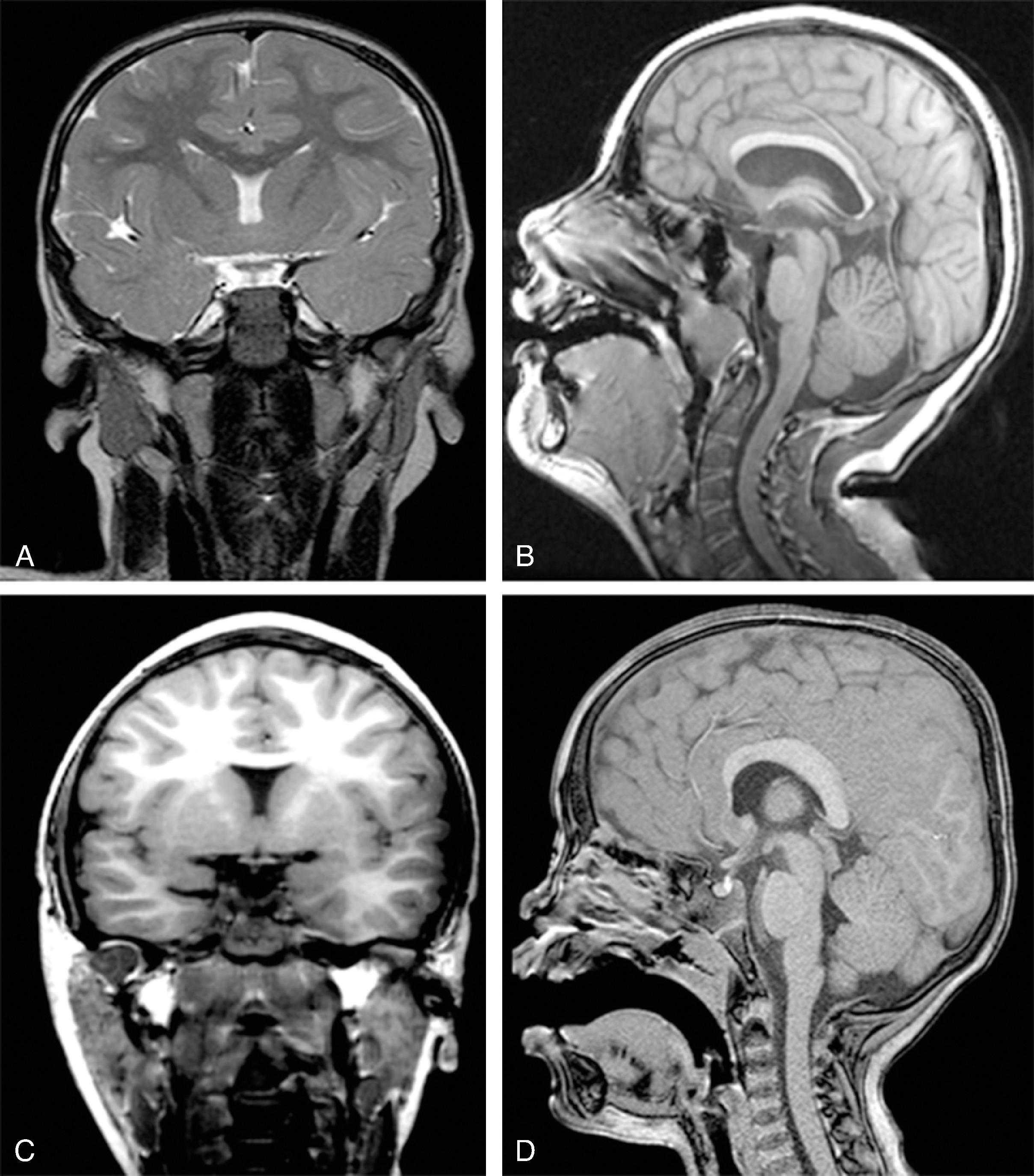 Fig. 2.64, Lobar Holoprosencephaly .