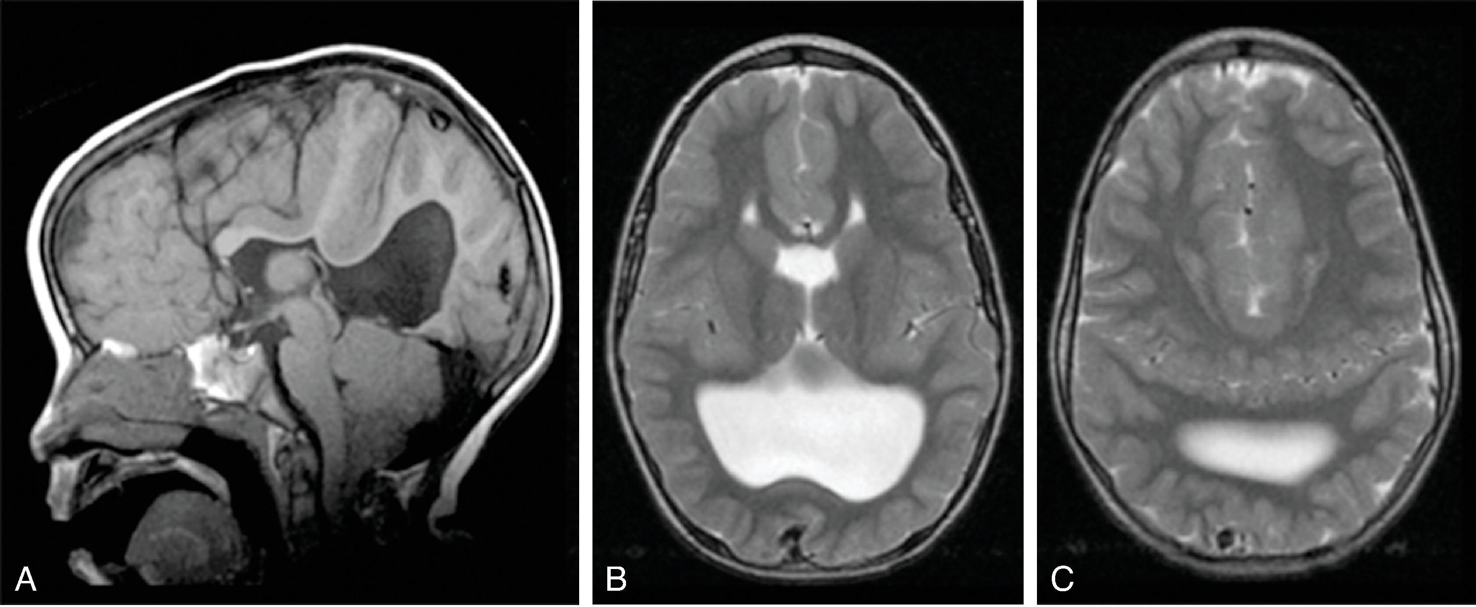 Fig. 2.65, Syntelencephaly .