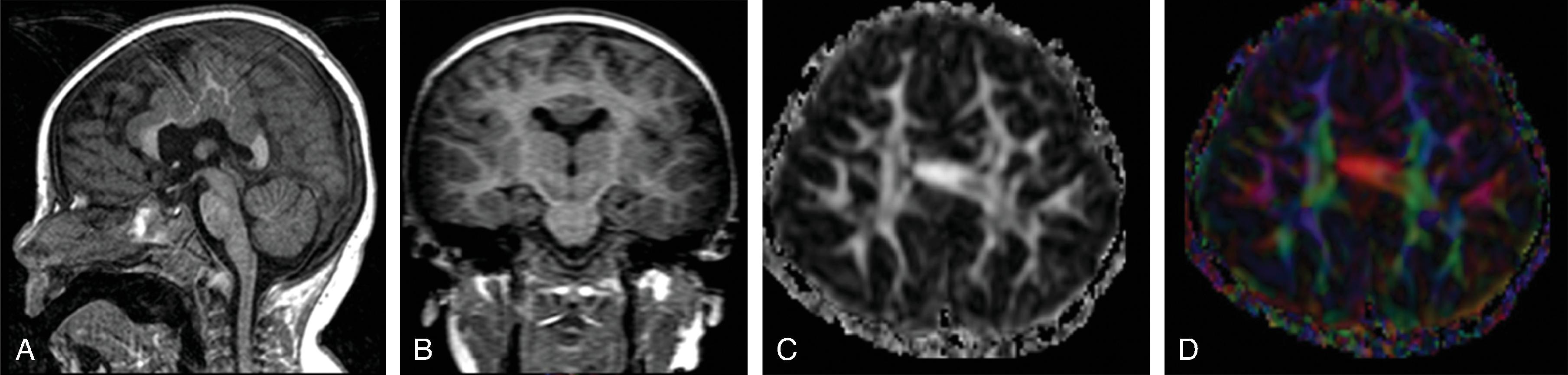 Fig. 2.66, Syntelencephaly .