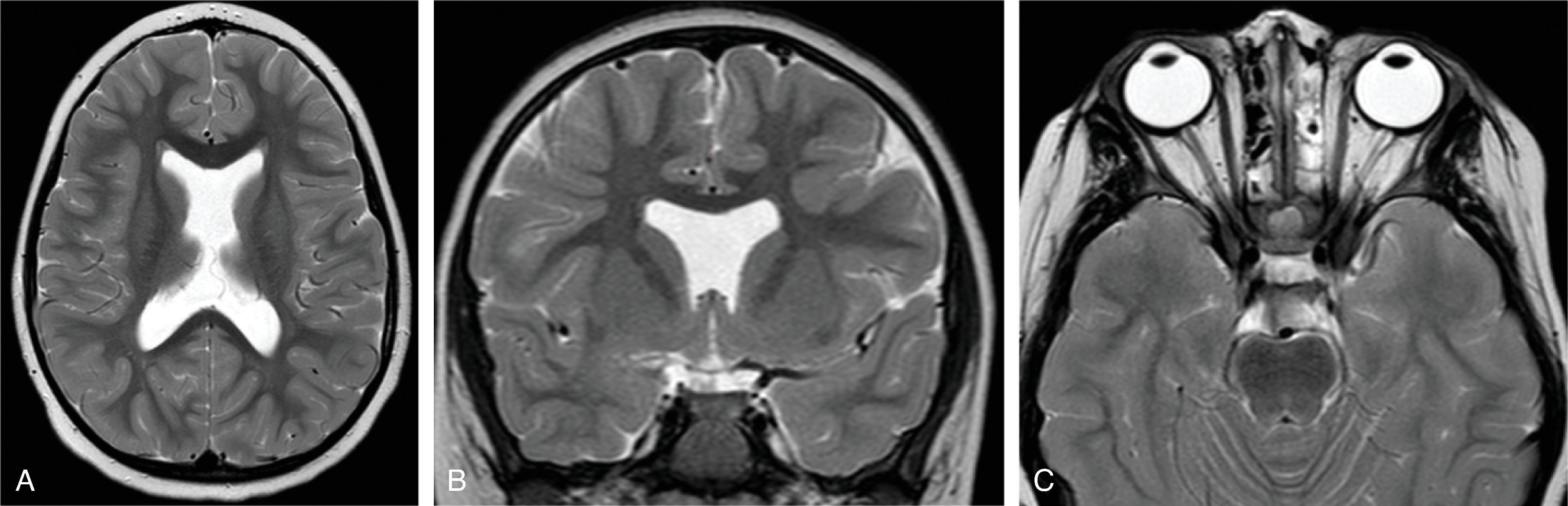 Fig. 2.67, Septo-optic Dysplasia .