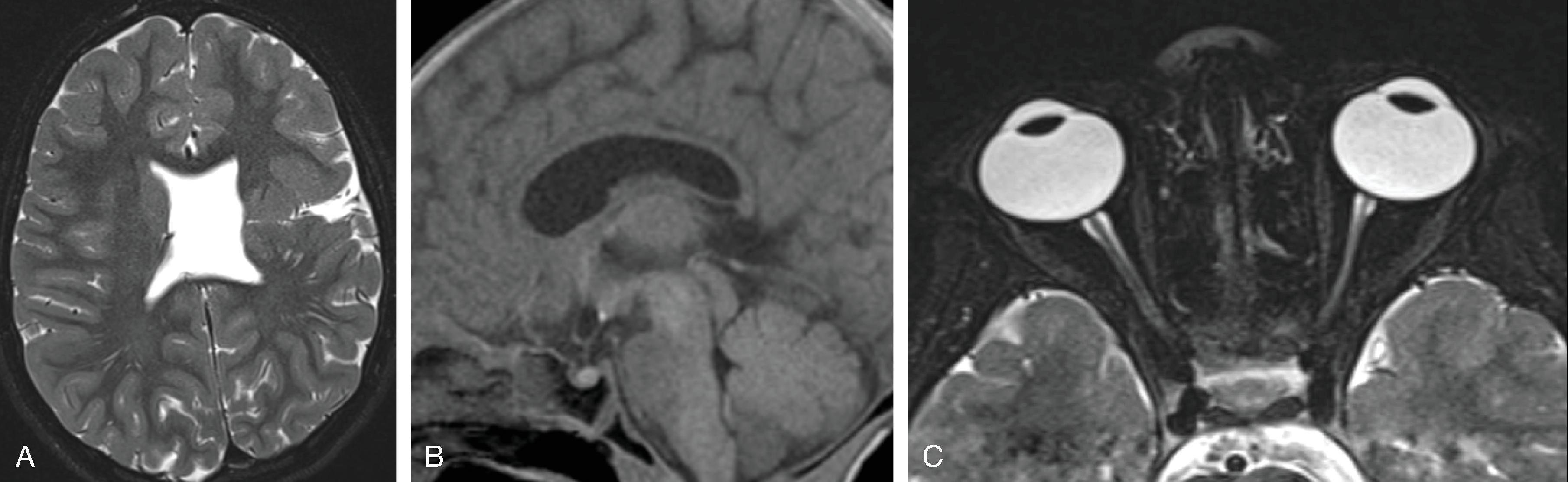 Fig. 2.68, Septo-optic Dysplasia .