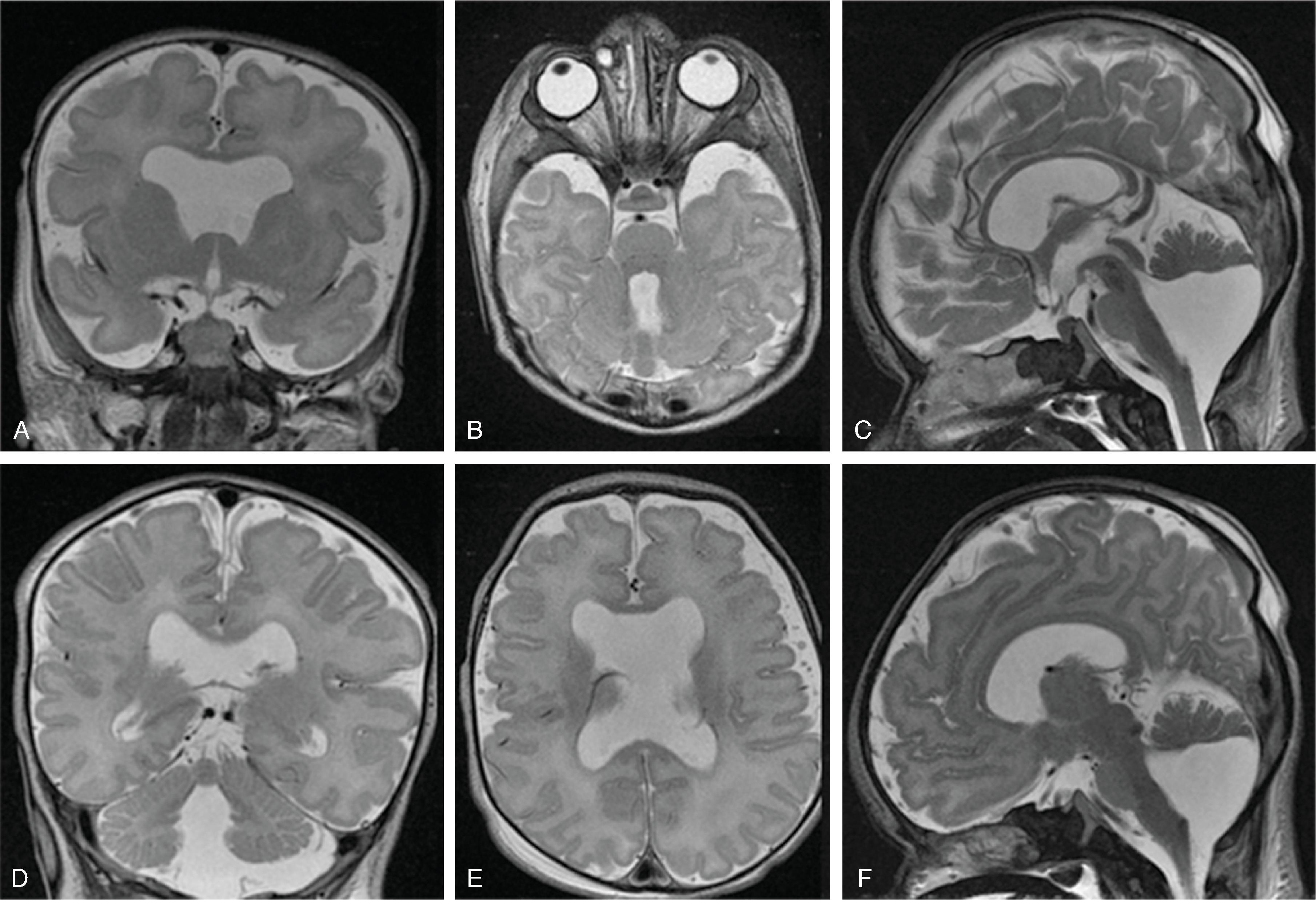 Fig. 2.71, Absent Septum Pellucidum .