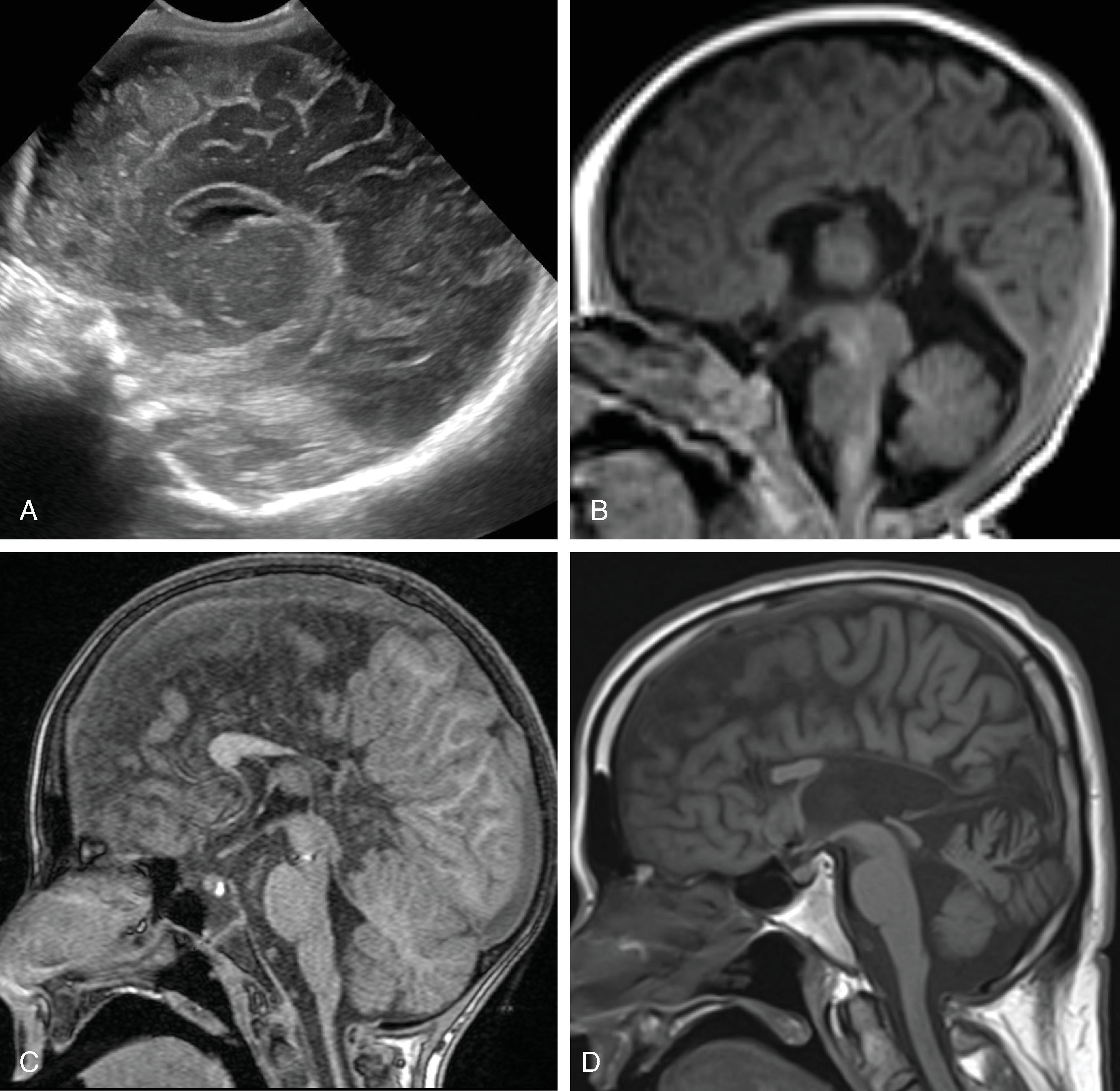 Fig. 2.7, Hypogenesis of the Corpus Callosum .