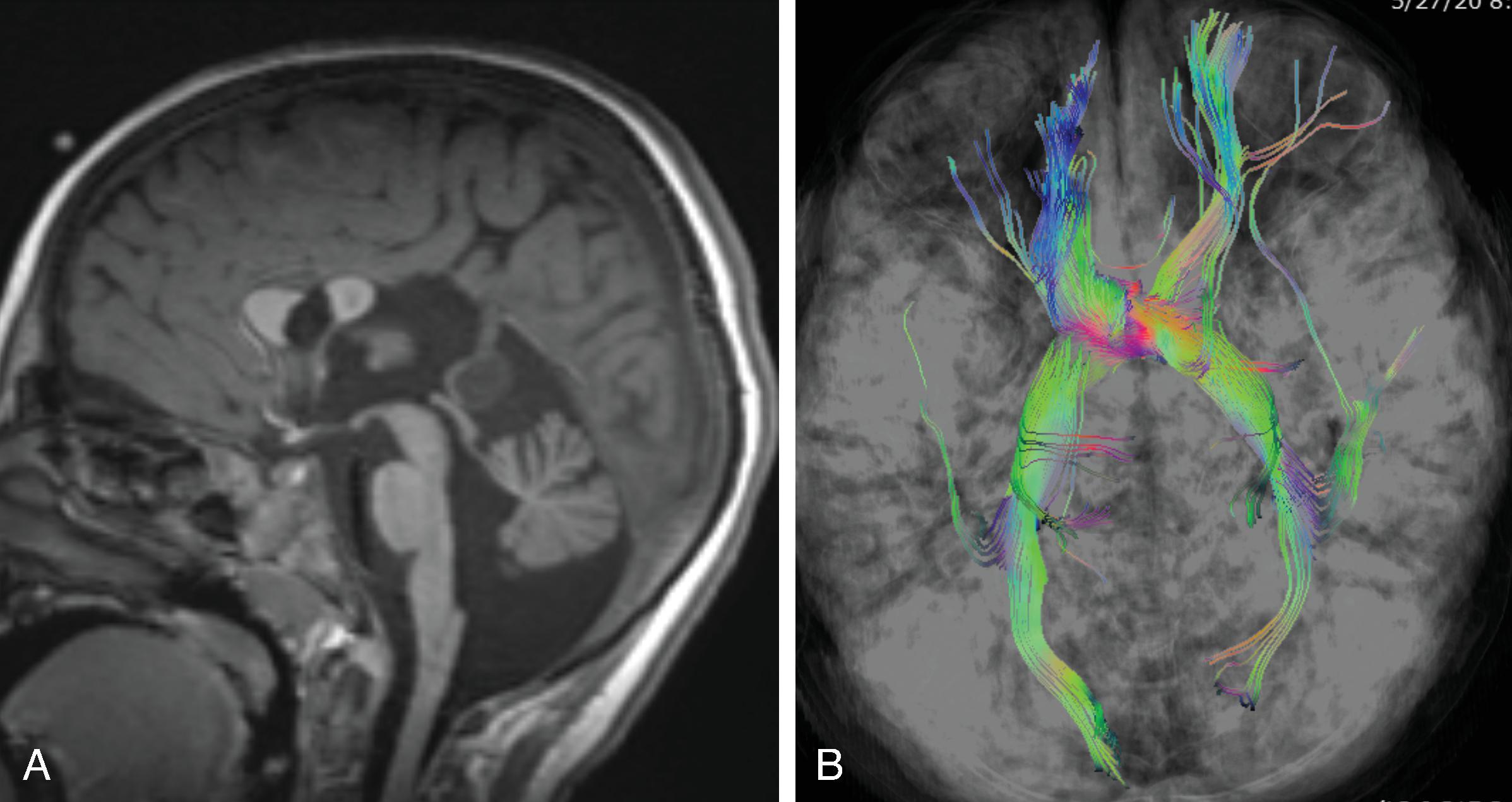 Fig. 2.8, Dysgenesis of the Corpus Callosum .