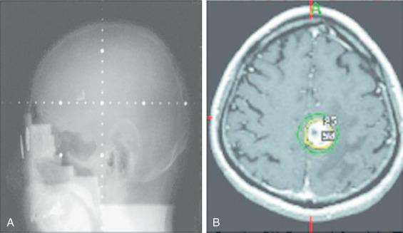 Figure 55.2, (A) A double-exposed portal image of a typical whole-brain radiotherapy field showing radiation covering the entire brain. The patient's eyes and other extracranial structures are blocked (right) . (B) Postcontrast T1-weighted magnetic resonance imaging of a brain metastasis shown on the day of radiosurgery with superimposed 50% and 25% isodose contours. A dose of 17.5 Gy was prescribed at the 50% isodose contour (left) .