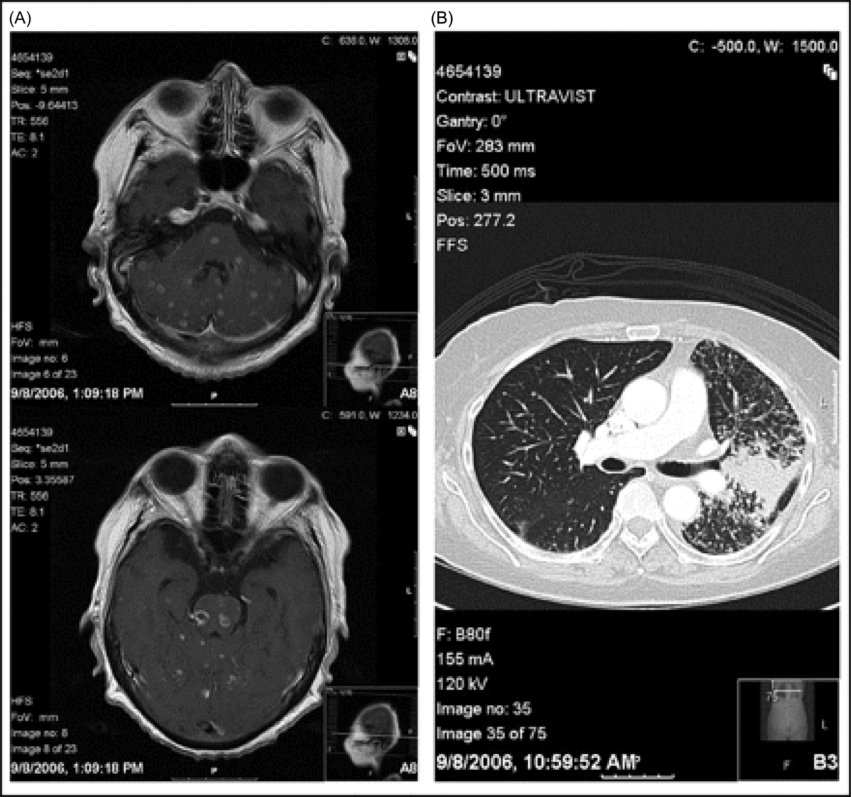 Figure 14.1, Magnetic resonance imaging (A) revealed recurrent disease within the brain, and a computed tomography scan of the chest (B) demonstrated progression of her disease ( Fekrazad et al., 2007 ).