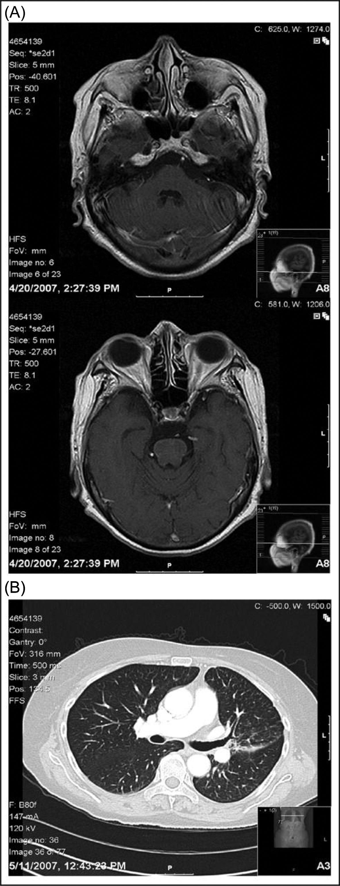 Figure 14.2, A follow-up magnetic resonance imaging of the brain obtained after 8 months of erlotinib therapy (A) demonstrated a complete resolution of the brain metastases, and a computed tomography scan of the chest obtained at that time revealed a partial remission of her primary disease (B) ( Fekrazad et al., 2007 ).