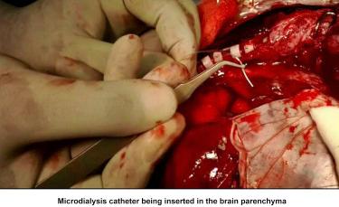 Figure 8.3, Intraoperative procedure for insertion of micro dialysis catheters into brain parenchyma.
