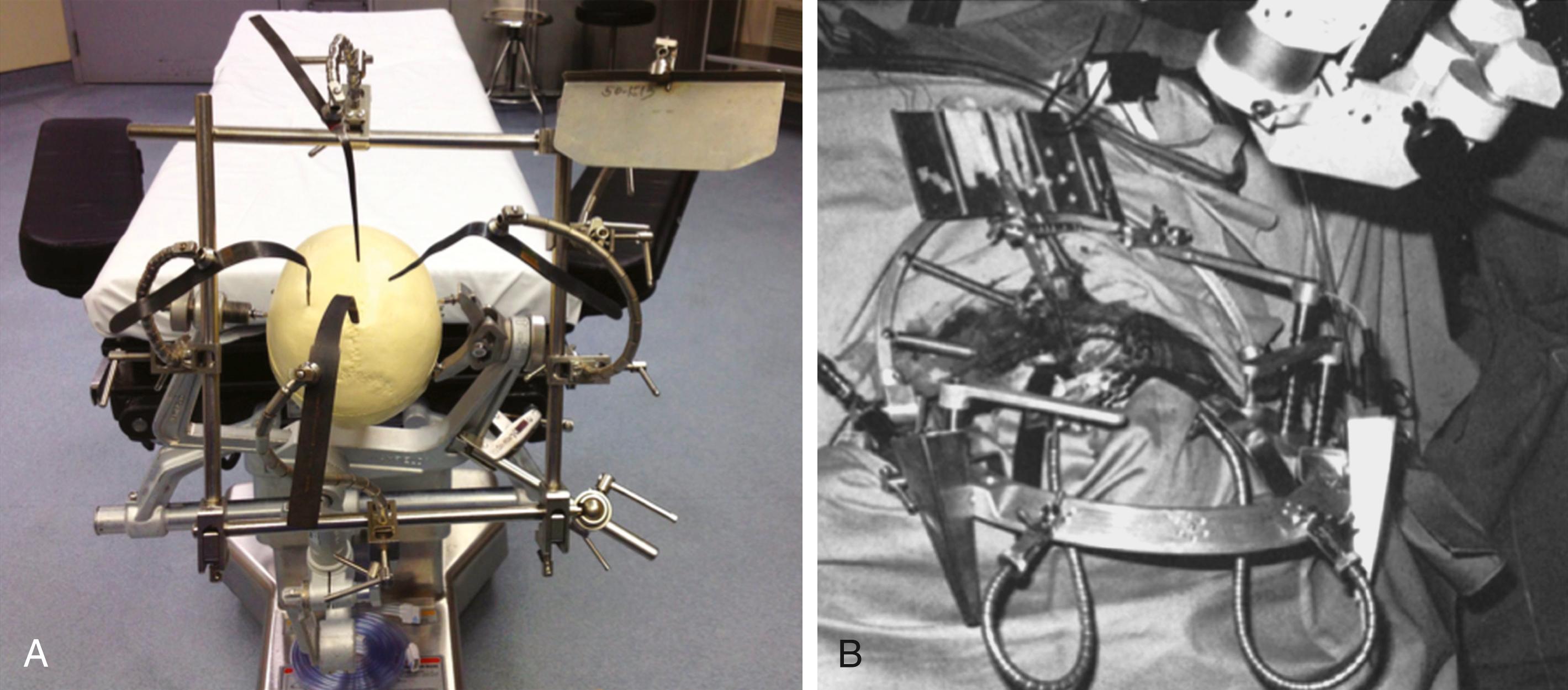 eFigure 33.12, (A) The Greenberg staircase organization technique described in 1981 to support microinstruments. It consists of multiple flexible ball-cable retractor arms that are attached to a squared framework around the operative field. (B) Photograph of the Sugita head frame with handrests and microneurosurgical accessories described by Sugita and colleagues in 1978. The head holder is strong enough to hold both the patient’s head and the accessories such as bipolar coagulation device, forceps, suction tubes, or other instruments, along with the self-retaining retractor.