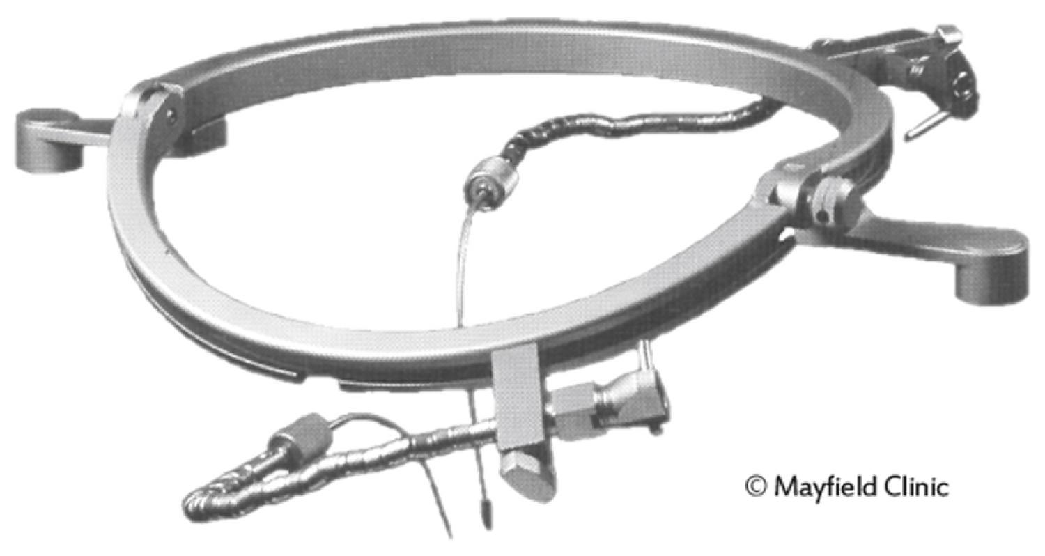 eFigure 33.13, The Budde Halo brain retractor, consisting of a circular frame that allows surgeons to comfortably rest their hands while the flexible self-retaining retractors hold brain tissue for greater exposure.