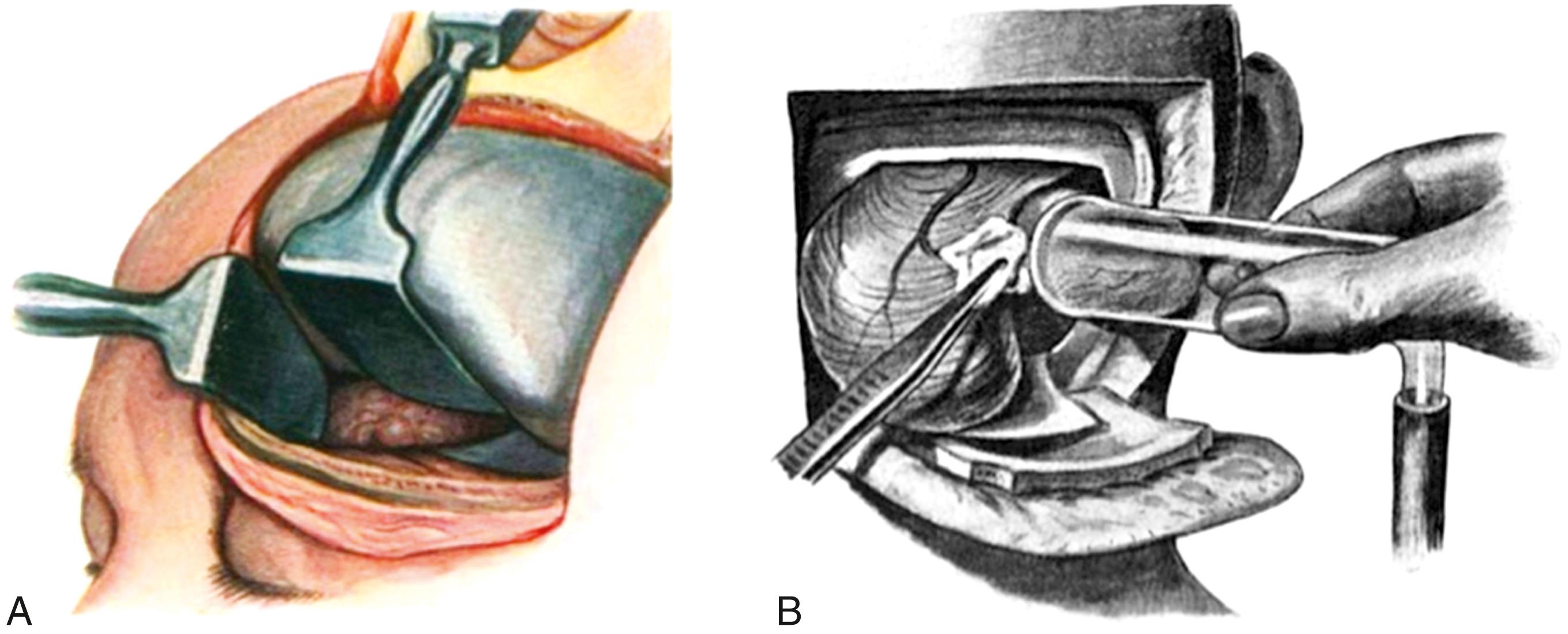 eFigure 33.3, (A) Krause’s retraction of the frontal lobe with a handheld retractor to approach a skull base meningioma. (B) In this illustration, Krause used a new method that involved vacuum suction of the tumor mass to assist in a nontraumatic dissection, especially within the posterior fossa.