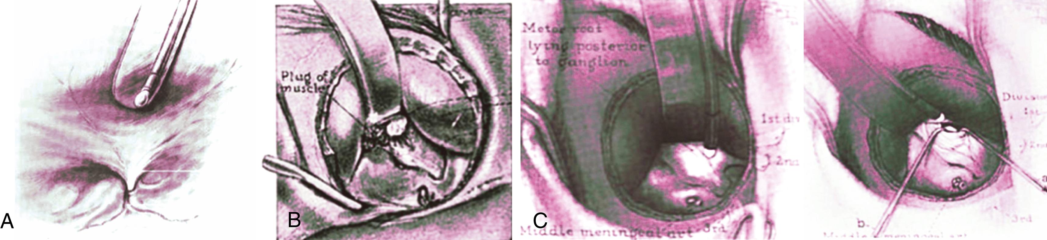 eFigure 33.4, (A) Illustration of Frazier’s lighted retractor to visualize the groove of the middle meningeal artery on the floor of the middle fossa, as described in his chapter The Surgery of the Fifth (Trigeminal) Nerve. (B) Adson’s use of an illuminated retractor in treatment of trigeminal neuralgia in 1920. (C) Adson’s illuminated retractor used to elevate the temporal lobe in exposure of the gasserian ganglion.