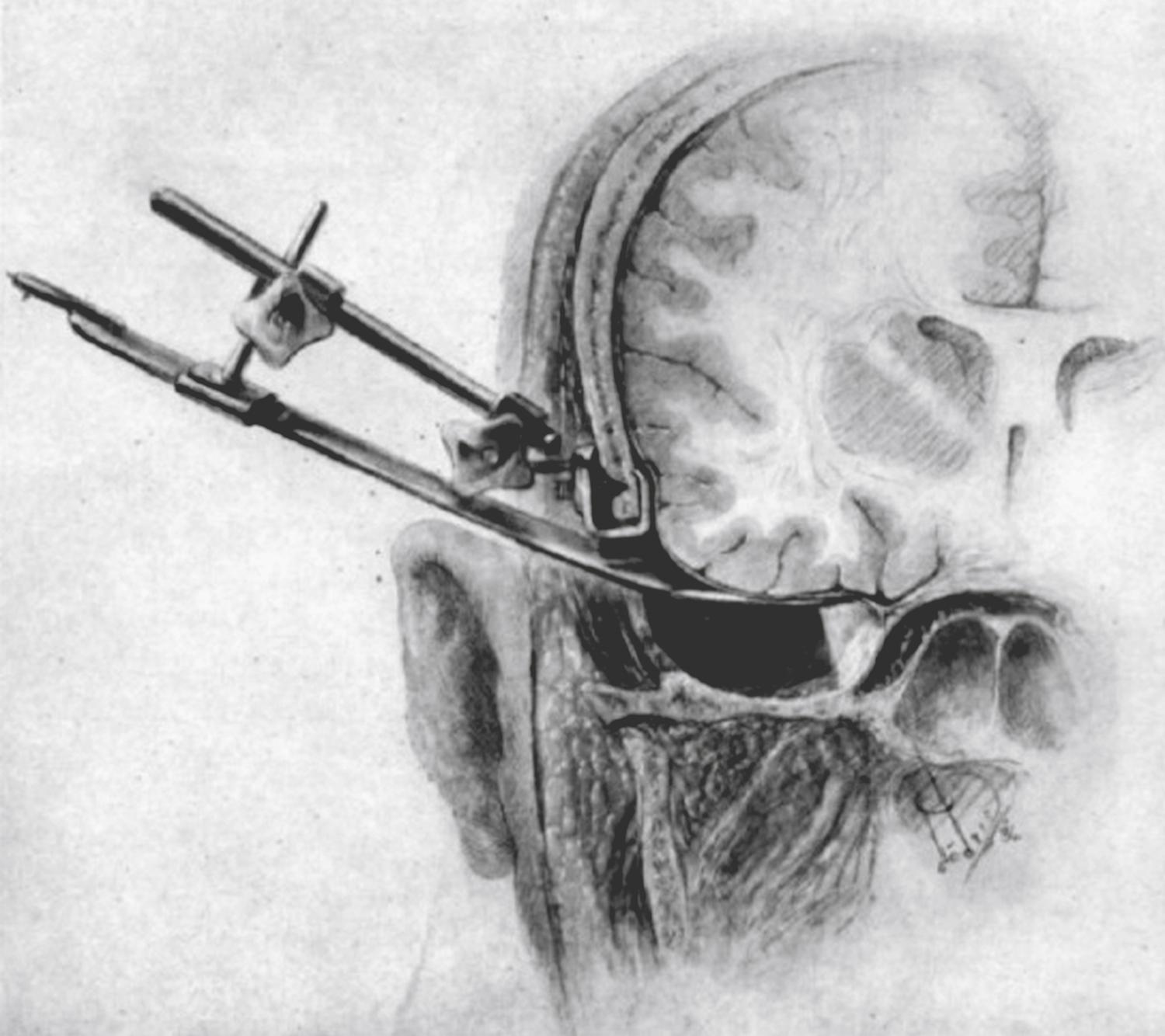 eFigure 33.7, Illustration of Hamby’s skull-mounted clamp and lighted retractor for exposure of the gasserian ganglion.