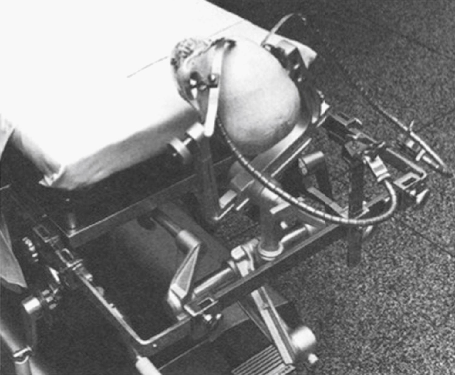 eFigure 33.10, In this photograph, a Yaşargil-Leyla brain retractor with double arm has been attached to the extracranial holder. This equipment is positioned for a right-sided craniotomy.