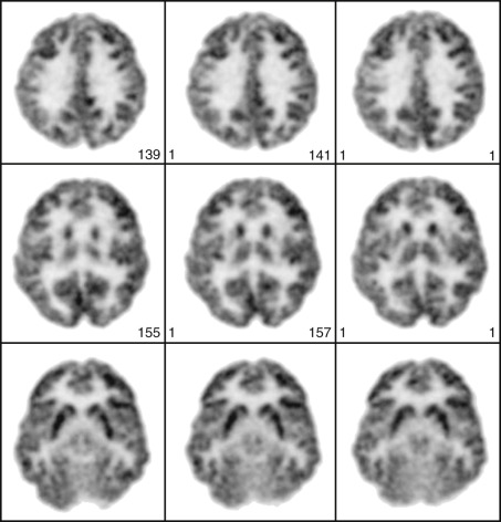 Figure 83-1, Normal findings on FDG PET brain scan. Note normal metabolism throughout cortical and subcortical regions. Metabolism is uniform and symmetric without focal defects. SPECT scans typically show a similar pattern of radiotracer uptake although spatial resolution on SPECT is worse than that on PET.