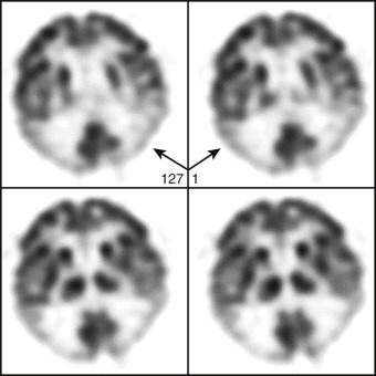 Figure 83-2, AD on FDG PET brain scan. Note reduced metabolism in temporoparietal regions of brain bilaterally ( arrows ). Frontal lobe and subcortical metabolism is relatively preserved.