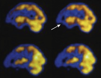 Figure 83-3, FTD on FDG PET brain scan (sagittal plane). Note marked reduction of metabolism in frontal lobes ( arrow ). Posterior metabolism in the parietal regions is preserved.