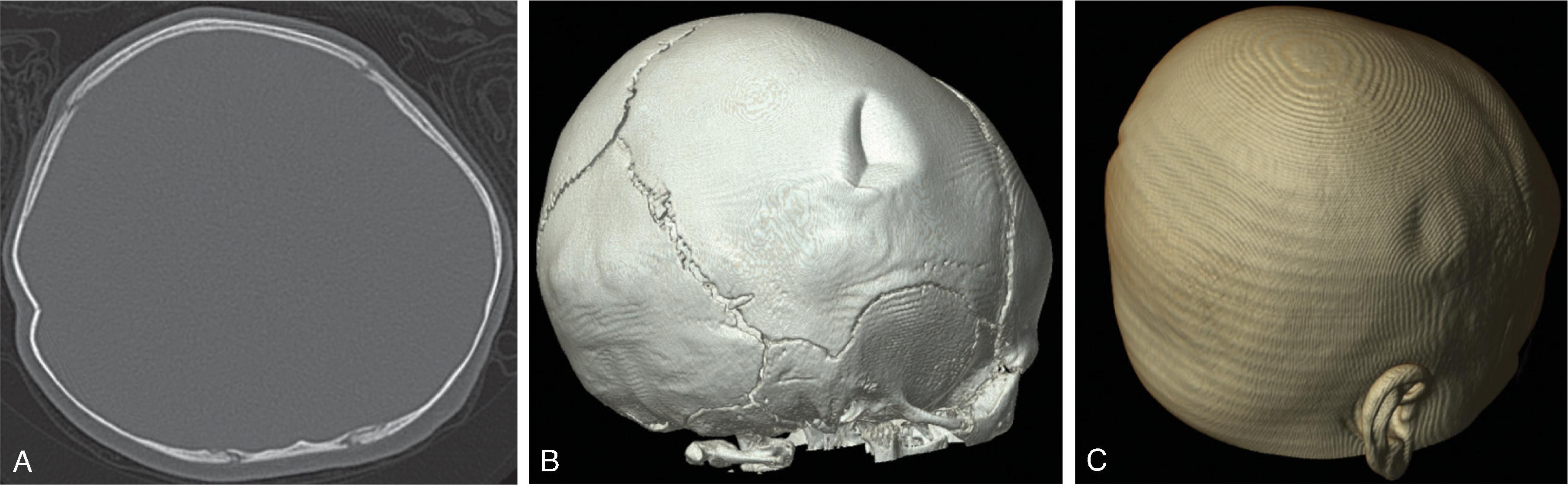 Fig. 10.13, Ping Pong Fracture . (A) axial head CT and (B and C) 3D volumetric CT images demonstrate a ping pong fracture of the right parietal bone with characteristic internal depression and angulation and noticeable contour deformity of the scalp.