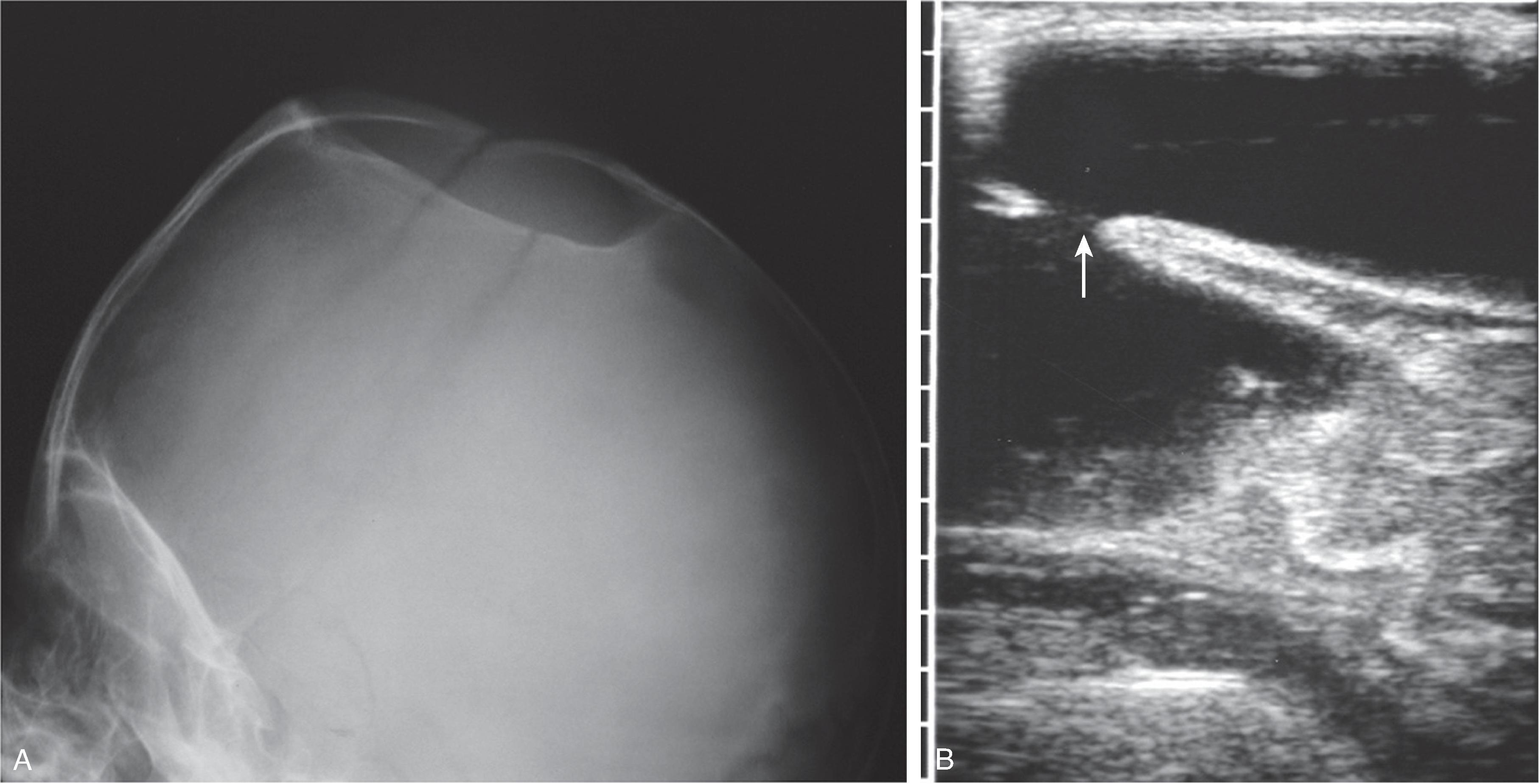 Fig. 10.15, Leptomeningeal Cyst: Radiograph and Ultrasound Appearance . (A) Sagittal skull radiograph demonstrating a large ovoid lucency in the skull. (B) Focused ultrasound image demonstrating a scalp fluid collection extending and communicating with the intracranial extraaxial space through a skull defect (arrow).