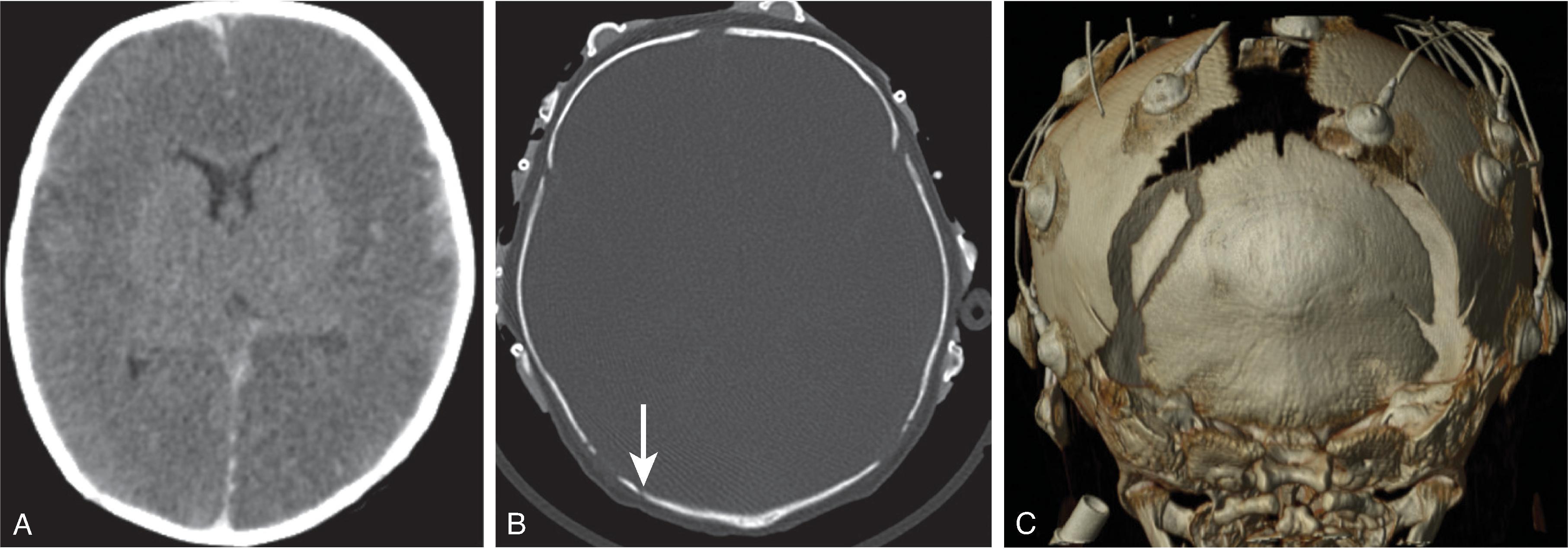 Fig. 10.18, Accessory Suture . (A and B) Axial CT images demonstrate large regions of parenchymal edema, hyperdensities in the subarachnoid spaces concerning for hemorrhage, and a lucency in the right side of the occipital bone concerning for a fracture ( arrow ). These findings were concerning for potential abusive head trauma. (C) 3D volumetric CT image, however, shows the sutures are widened and the right occipital lucency is a widened accessory suture. The infant was found to have bacterial meningitis. Autopsy confirmed an accessory suture.