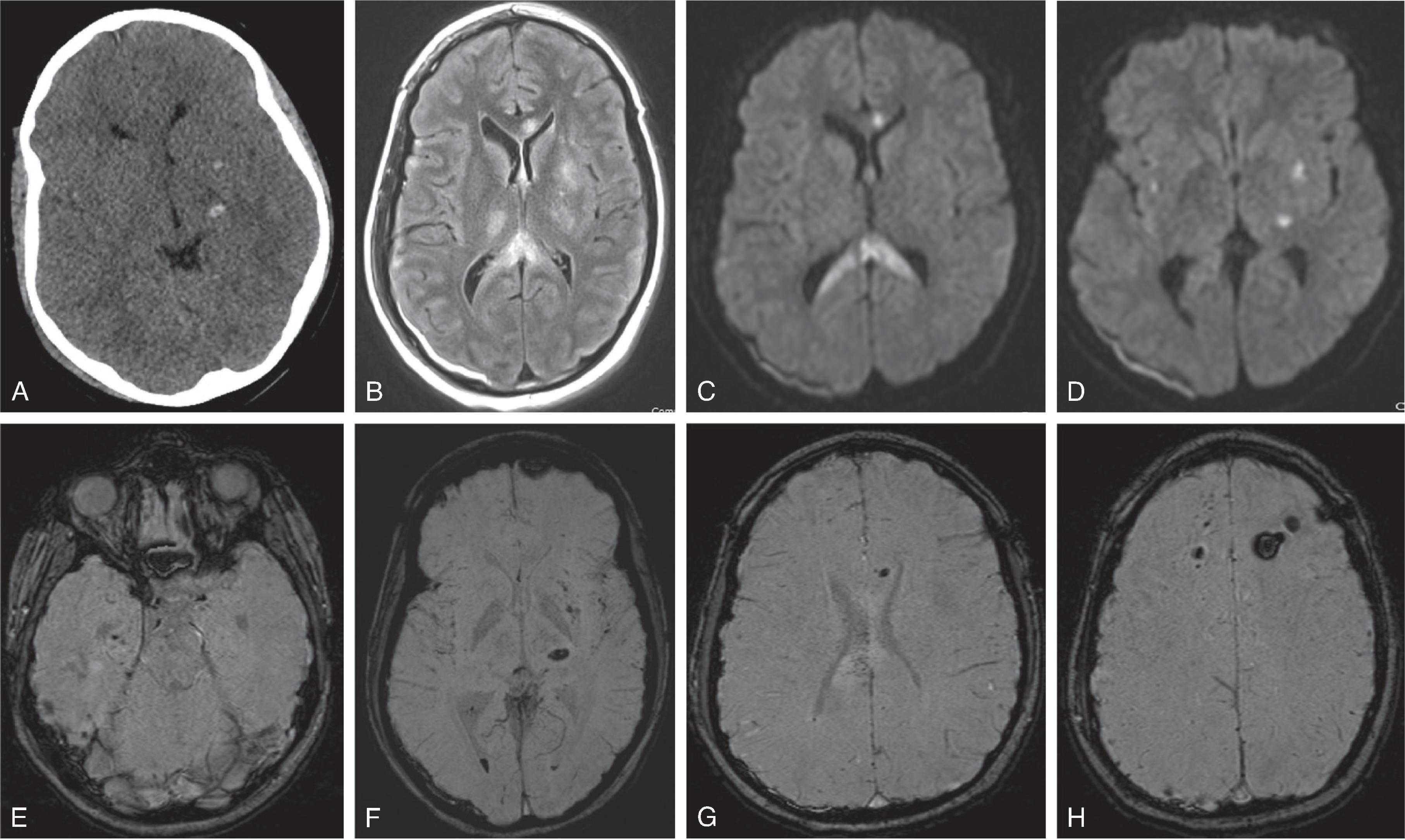 Fig. 10.20, Diffuse Axonal Injury . (A) Axial head CT demonstrating foci of acute hemorrhage in the left putamen and thalamus. (B) Axial FLAIR image demonstrating areas of hyperintensity in the corpus callosum, bilateral thalami, and left putamen in addition to a right occipital subdural hemorrhage. A small subdural hematoma is also present posterior to the right occipital lobe. (C and D) Axial DWI images demonstrate hyperintense signal in the corpus callosum, left thalamus, left putamen, and right subinsular white matter. The right occipital subdural hemorrhage is also seen. (E to H) Axial SWI images demonstrate multifocal susceptibility in the parenchyma consistent with hemorrhage from diffuse axonal injury.