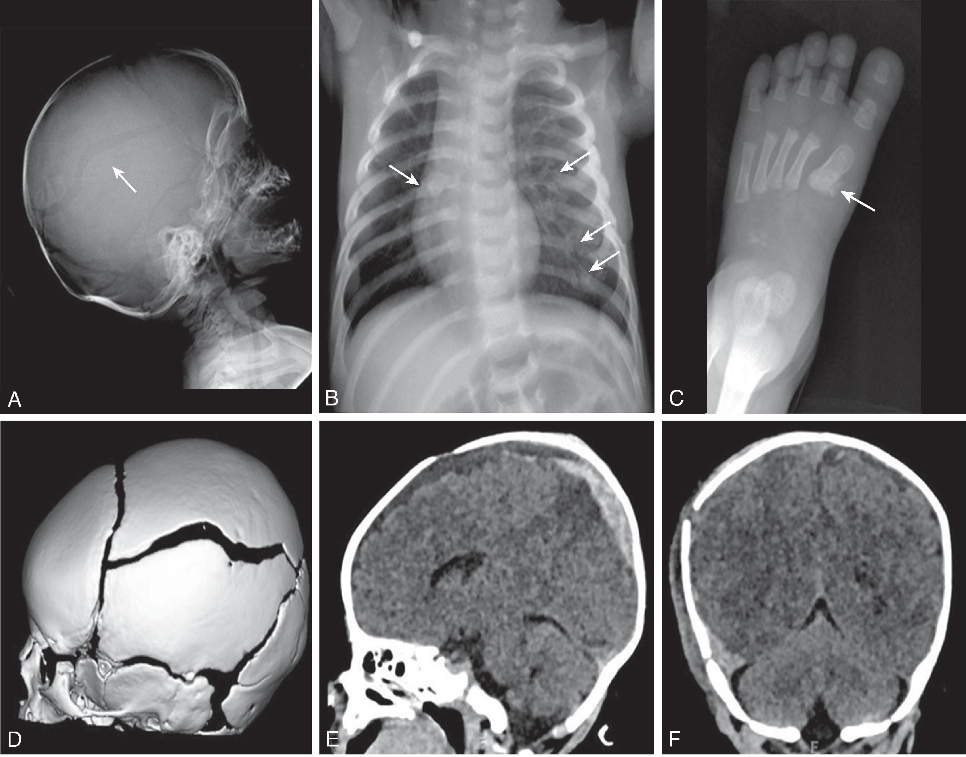 Fig. 10.22, Abusive Head Trauma . (A) Lateral skull radiograph demonstrates a linear parietal bone lucency due to a fracture ( arrow ). (B) AP chest radiograph demonstrates bilateral healing rib fractures ( arrows ). (C) AP foot radiograph demonstrates a healing first metatarsal fracture ( arrow ). (D) 3D volumetric CT demonstrates the parietal bone fracture. (E and F) Sagittal and coronal head CT reformat images demonstrate mixed density subdural hemorrhage along the right cerebral hemisphere and right temporal scalp edema.