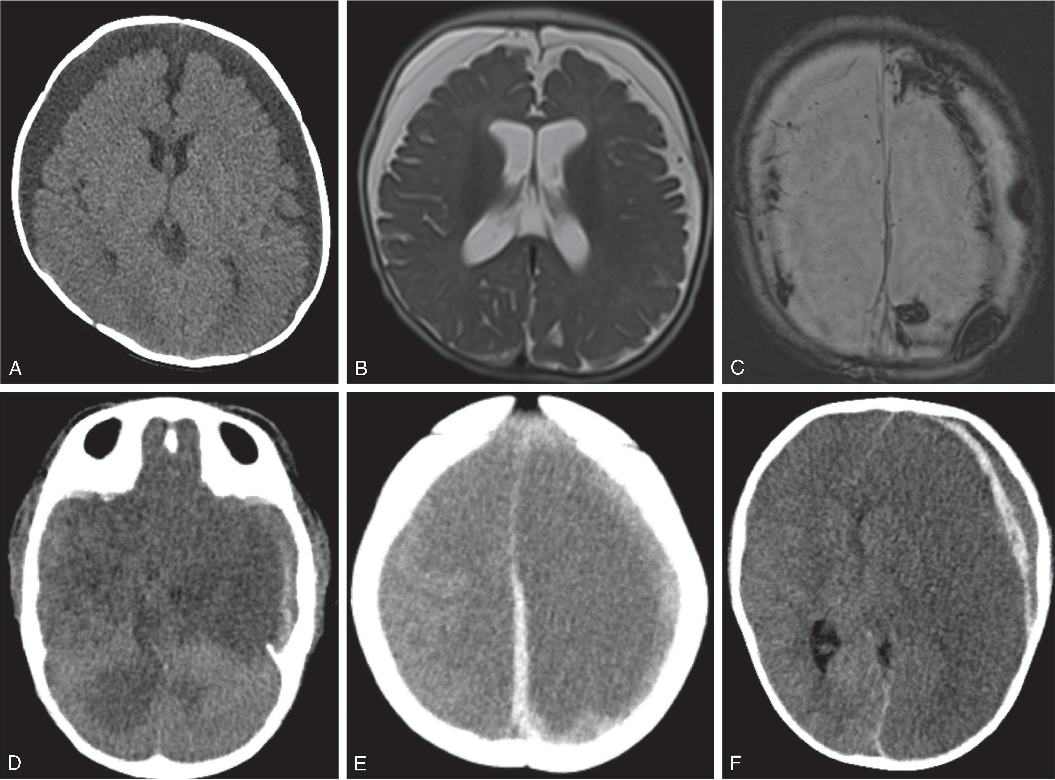 Fig. 10.25, Abusive Head Trauma: Subdural Hemorrhage Patterns . (A) Axial head CT demonstrates bilateral frontoparietal low-density extraaxial spaces. No vessels traverse these spaces, which should raise concern for subdural fluid collections. (B) Axial T2W images demonstrate bilateral frontal subdural fluid collections with septations. (C) Axial SWI image shows susceptibility from hemorrhage in the bilateral subdural spaces. (D and E) Axial head CT demonstrating hyperdense subdural hemorrhage along the falx and left cerebral hemisphere in addition to large regions of parenchymal ischemia. (F) Axial head CT demonstrating a mixed density subdural hematoma along the lateral left frontal lobe with associated large region of loss of gray and white matter differentiation, midline to the right, and subfalcine herniation of the frontal lobe.