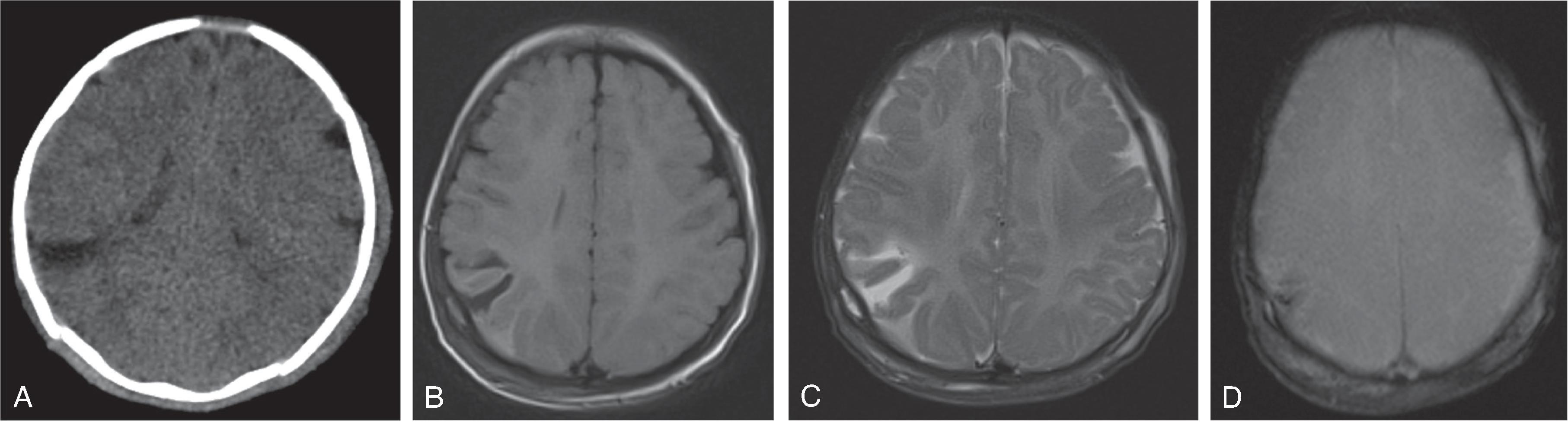 Fig. 10.30, Abusive Head Trauma: Parenchymal Laceration . (A) Axial CT head demonstrates a triangular low density in the right parietal lobe. (B) Axial FLAIR, (C) axial T2W, and (D) axial SWI images demonstrate a right parietal laceration with cleft-like fluid signal and hemorrhage.