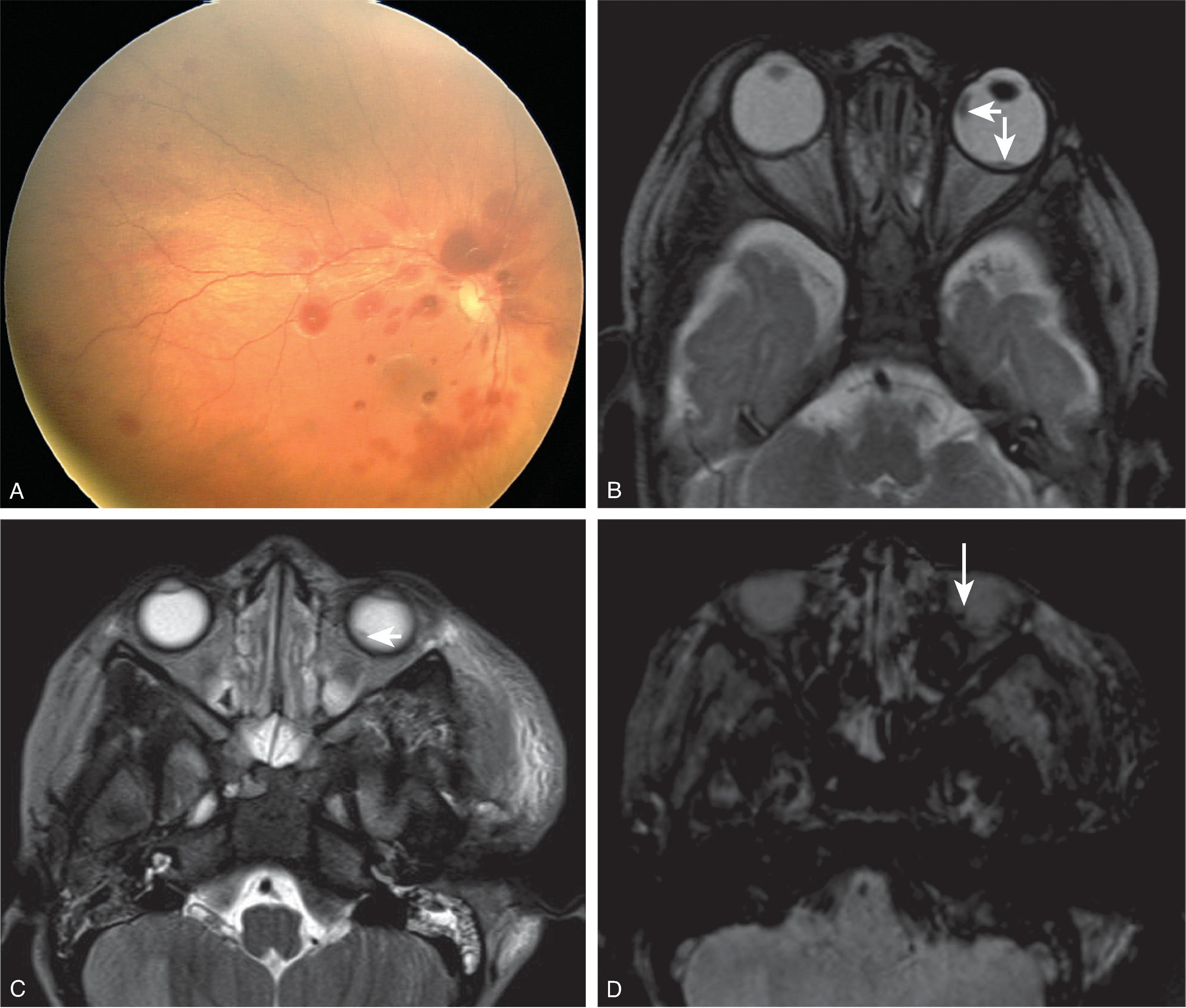 Fig. 10.33, Abusive Head Trauma: Retinal Hemorrhage . (A) RetCam photograph of preretinal, intraretinal, and subretinal hemorrhages, extending to the periphery. (B and C) Axial T2W and (D) axial SWI images demonstrate hypointense foci in the posterior globes and right media globe consistent with retinal hemorrhage. MRI should not be the primary diagnostic tool to identify retinal hemorrhages. (A Courtesy Tineke Chan, MD, Children’s Hospital of Pittsburgh, University of Pittsburgh Medical Center, Pittsburgh, PA. In Zitelli B, McIntire S, Nowalk A. Zitelli and Davis’ Atlas of Pediatric Physical Diagnosis . 7th ed. Elsevier; 2018.)